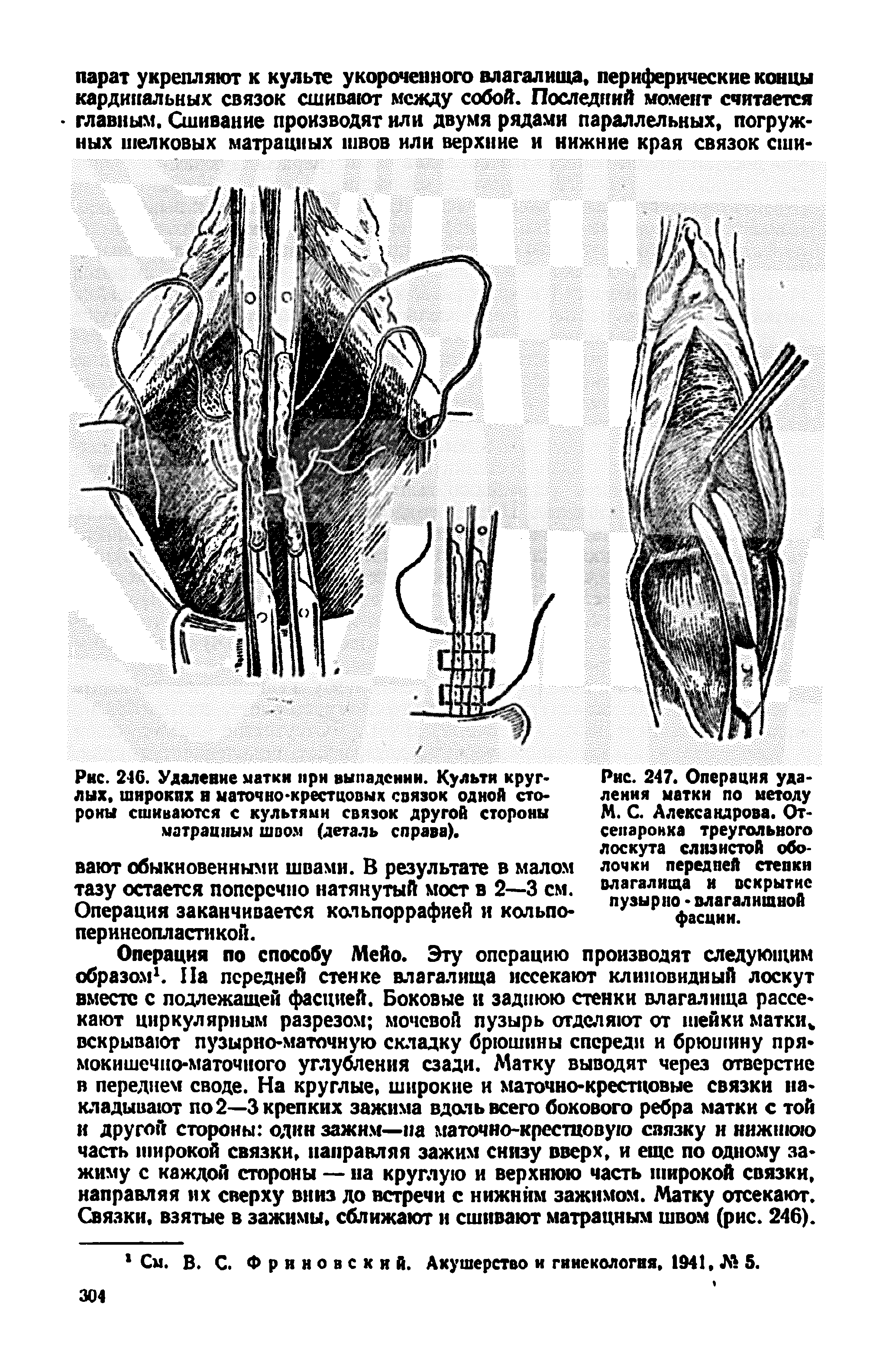 Рис. 246. Удаление матки при выпадении. Культи круглых. широких н маточно-крестцовых связок одной стороны сшиваются с культями связок другой стороны матрацным швом (деталь справа).