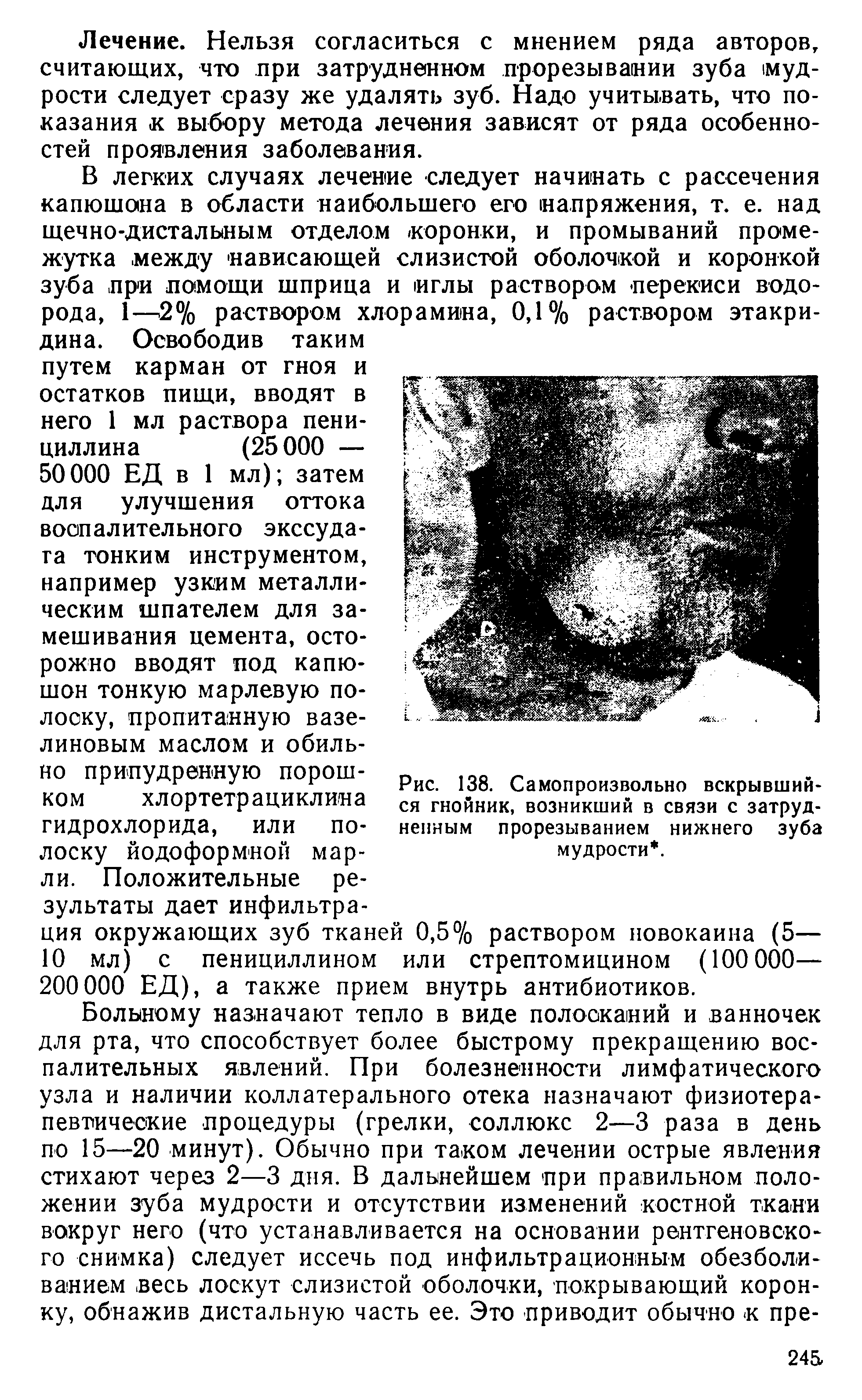 Рис. 138. Самопроизвольно вскрывшийся гнойник, возникший в связи с затрудненным прорезыванием нижнего зуба мудрости. ...