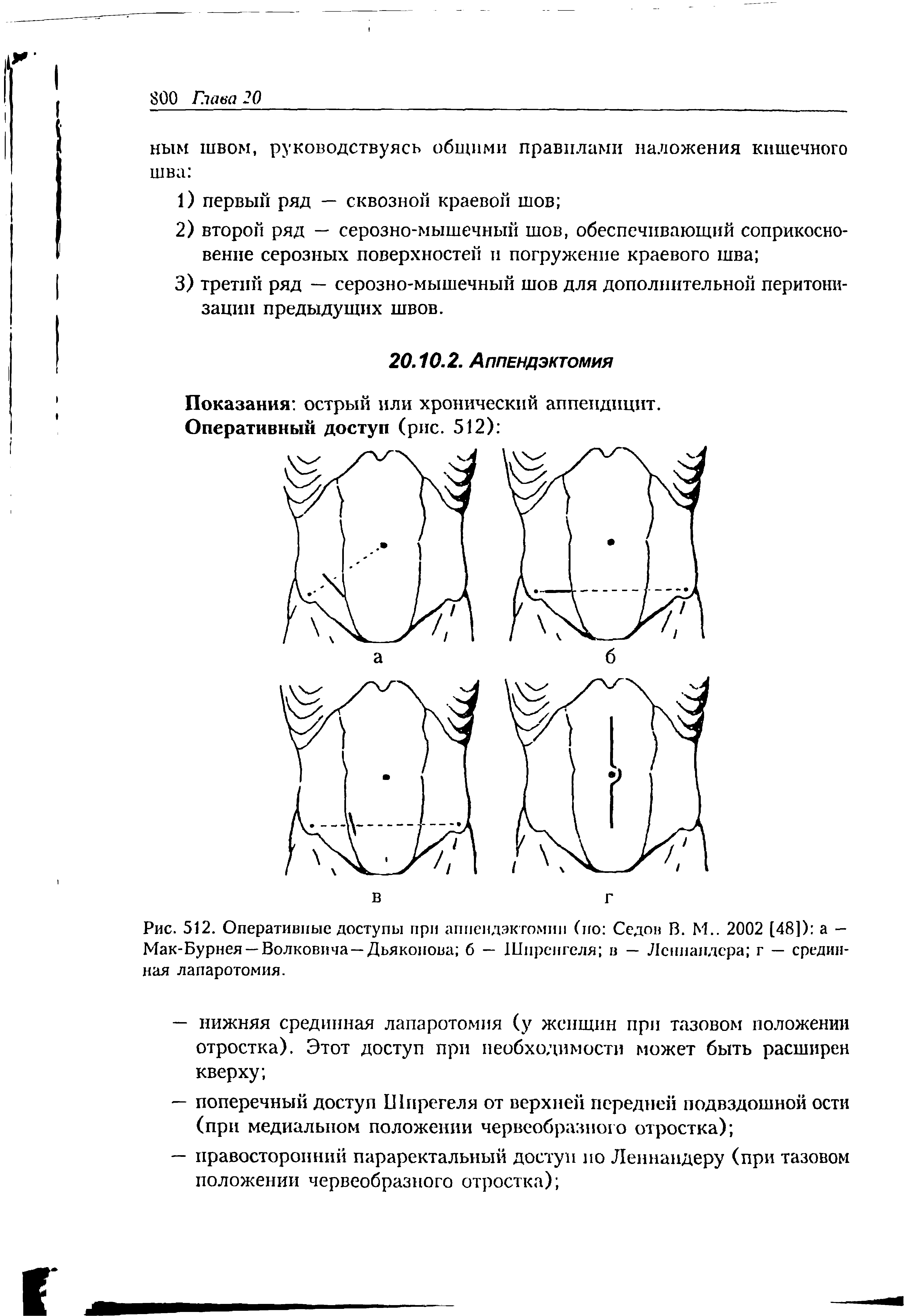 Рис. 512. Оперативные доступы при аппендэктомии (по Седов В. М.. 2002 [48]) а — Мак-Бурнея —Волковича — Дьяконова б — 1 Пирен геля в — Лсннапдсра г — срединная лапаротомия.