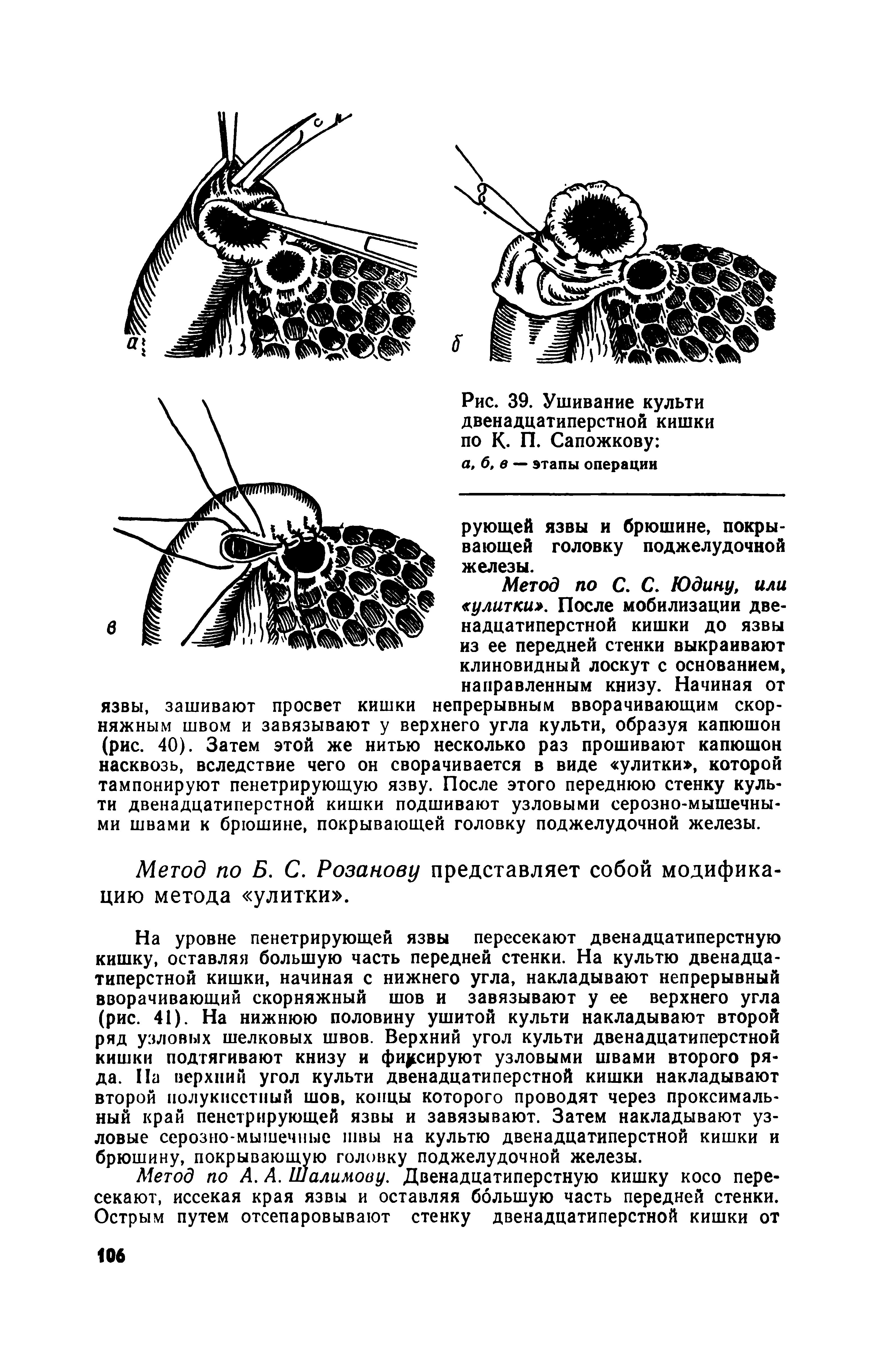 Рис. 39. Ушивание культи двенадцатиперстной кишки по К. П. Сапожкову а, б, в — этапы операции...