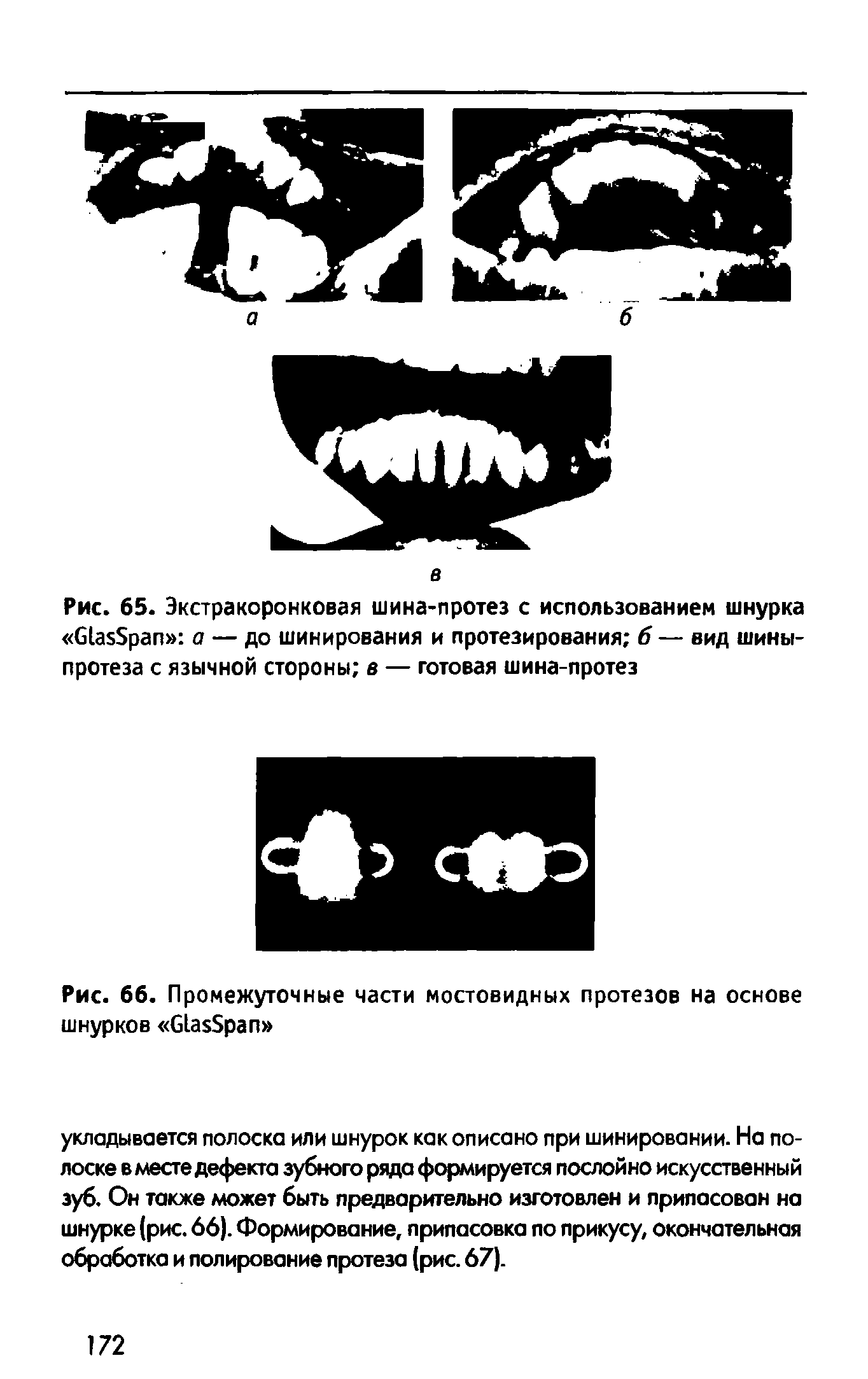 Рис. 65. Экстракоронковая шина-протез с использованием шнурка б Брап а — до шинирования и протезирования б — вид шины-протеза с язычной стороны в — готовая шина-протез...