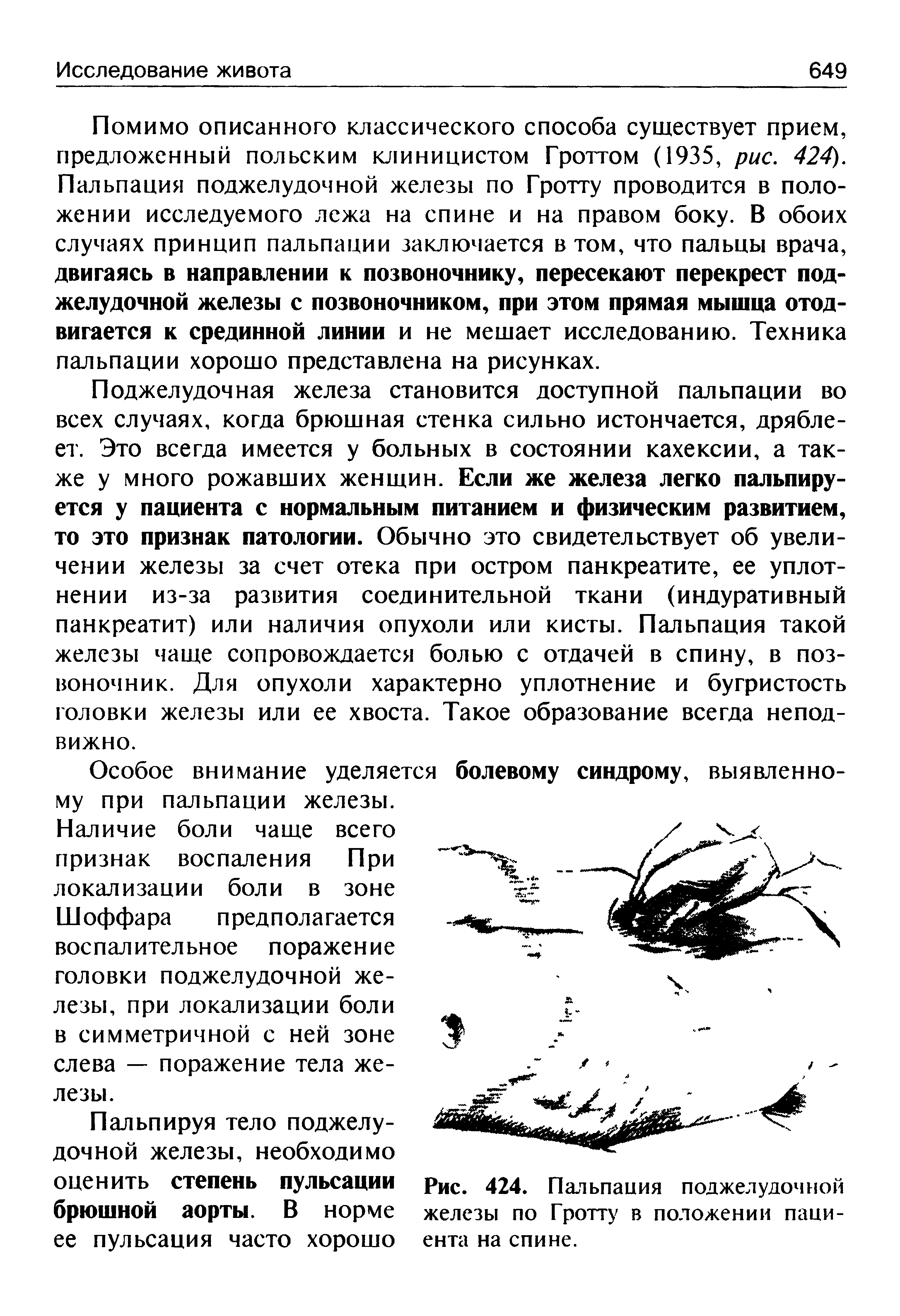 Рис. 424. Пальпация поджелудочной железы по Гротту в положении пациента на спине.