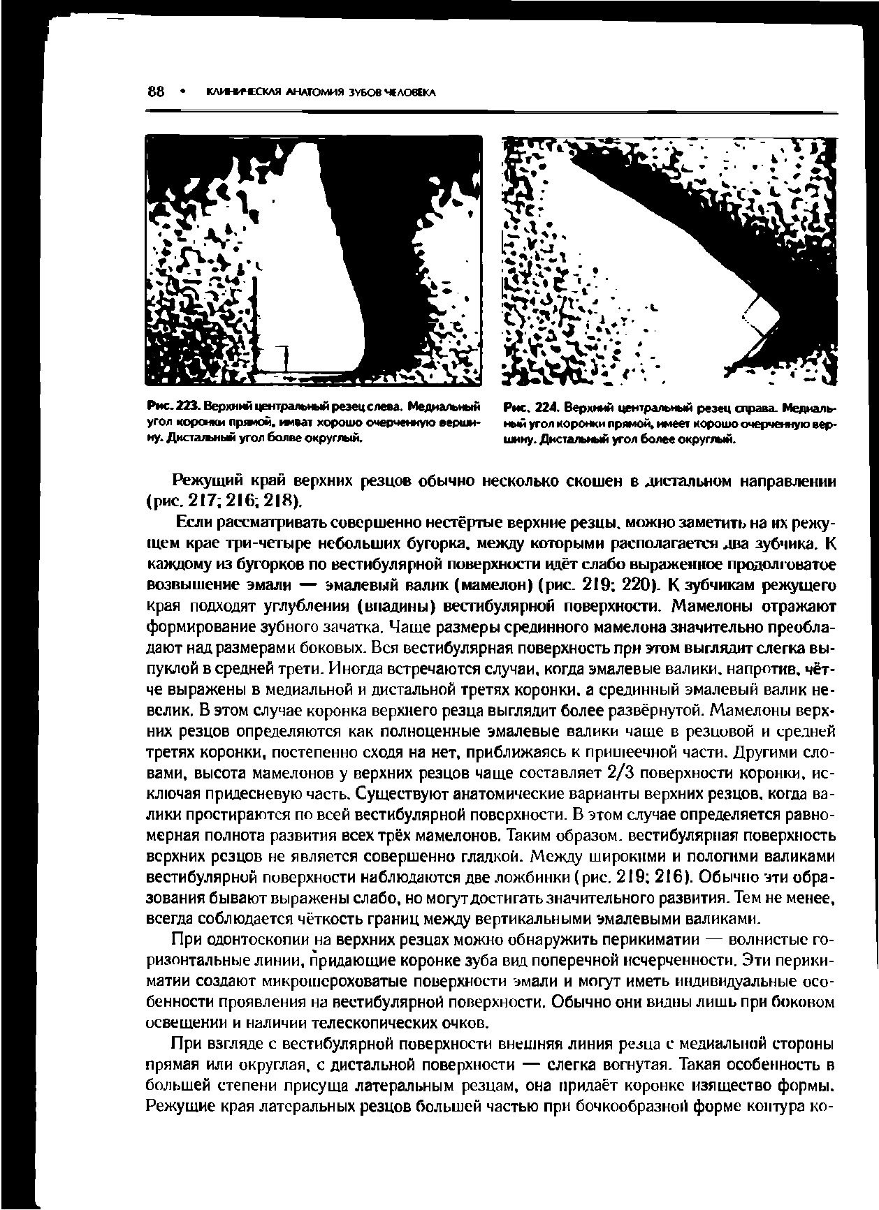 Рис. 224. Верхний центральный резец справа. Медиальный угол коронки прямой, имеет хорошо очерченную вершину. Дистальный угол более округлый.