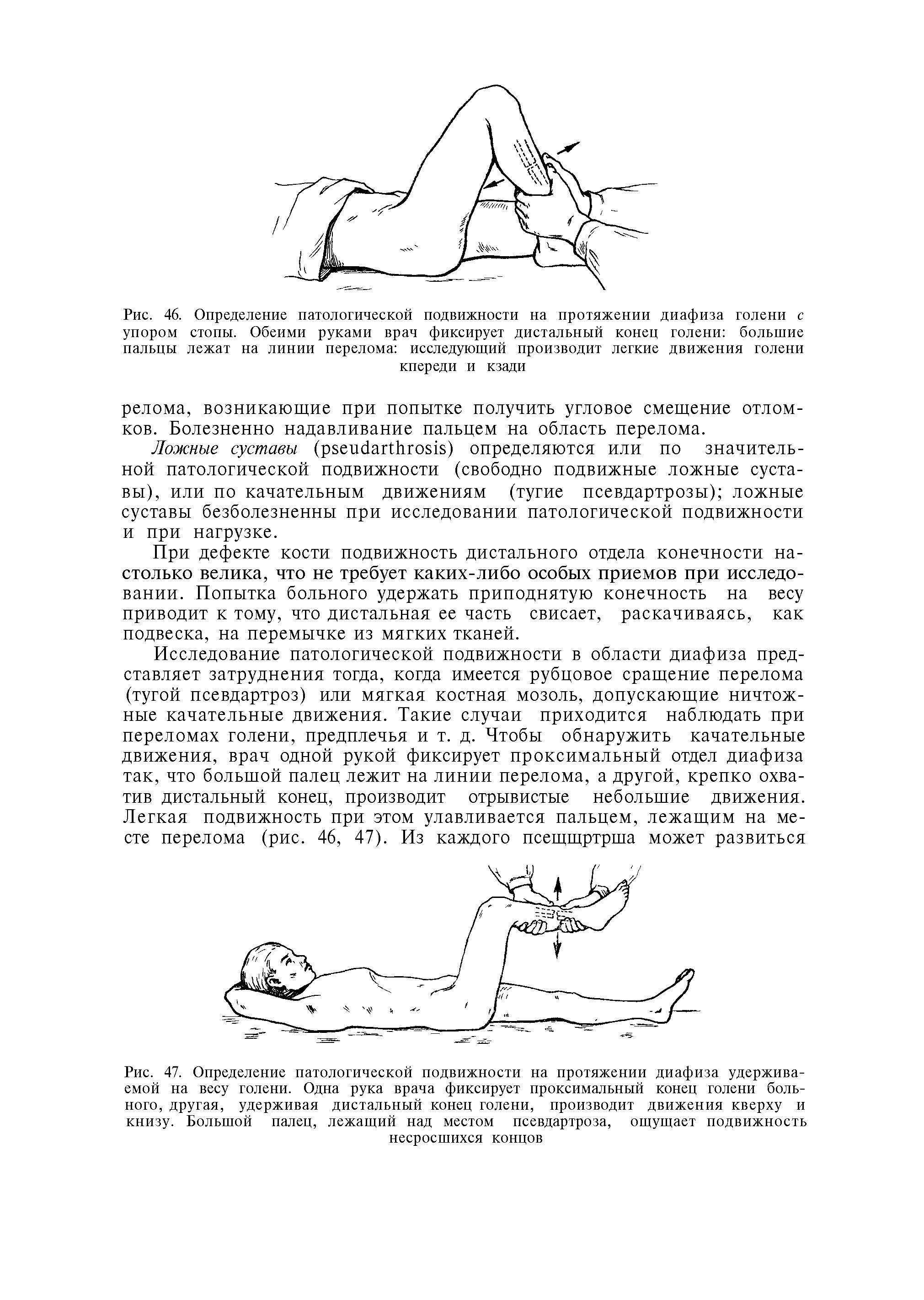 Рис. 47. Определение патологической подвижности на протяжении диафиза удерживаемой на весу голени. Одна рука врача фиксирует проксимальный конец голени больного, другая, удерживая дистальный конец голени, производит движения кверху и книзу. Большой палец, лежащий над местом псевдартроза, ощущает подвижность несросшихся концов...