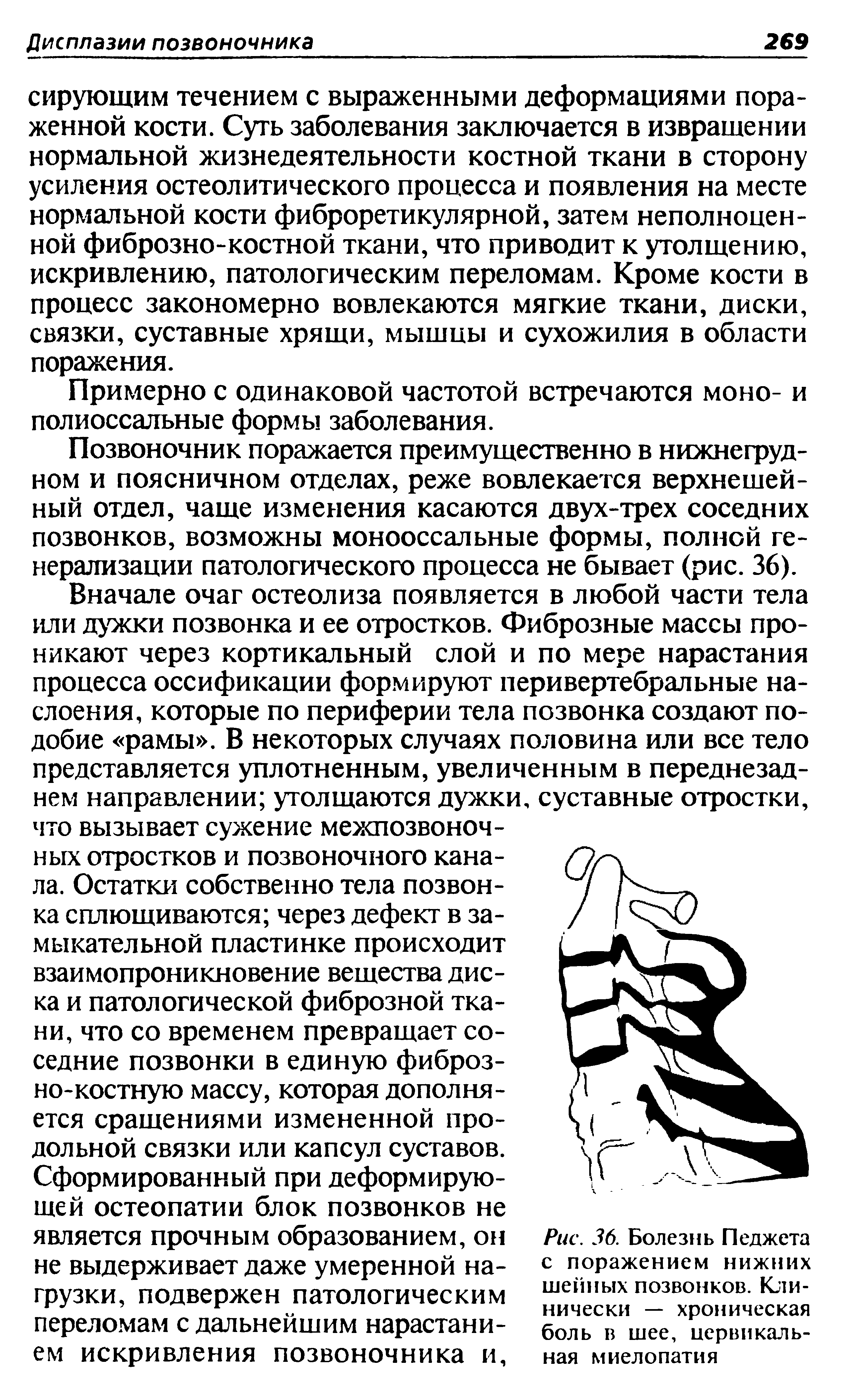 Рис. 36. Болезнь Педжета с поражением нижних шейных позвонков. Клинически — хроническая боль в шее, цервикальная миелопатия...