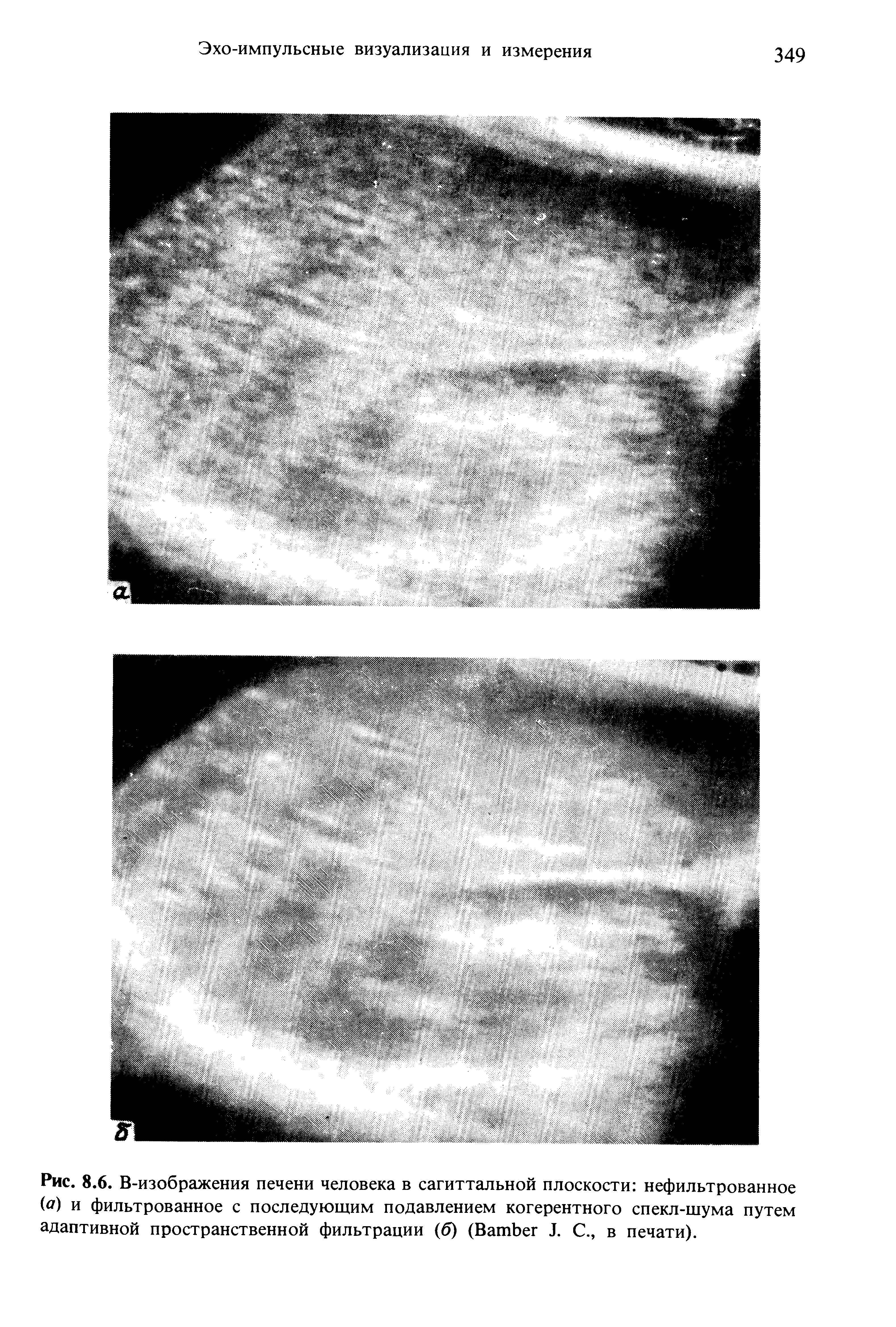 Рис. 8.6. В-изображения печени человека в сагиттальной плоскости нец>и. . (а) и фильтрованное с последующим подавлением когерентного спекл-шума путем адаптивной пространственной фильтрации (б) (ВатЬег Л. С., в печати).