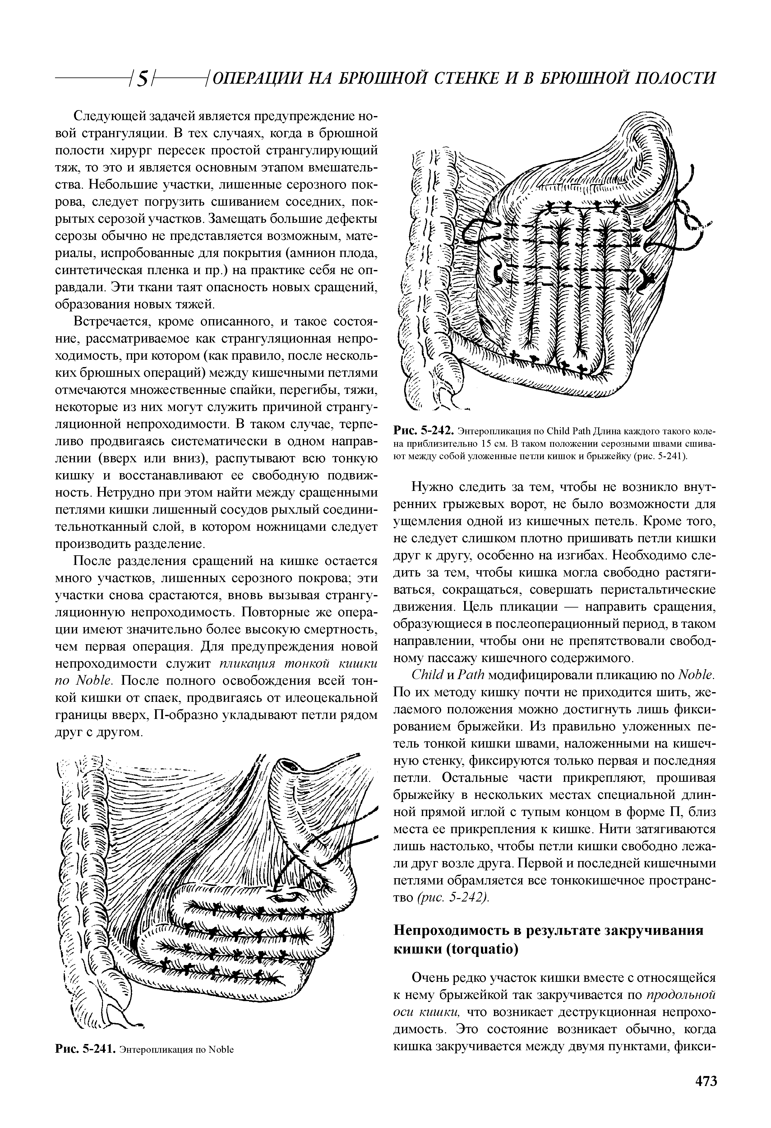 Рис. 5-242. Энтеропликация по C P Длина каждого такого коле-на приблизительно 15 см. В таком положении серозными швами сшивают между собой уложенные петли кишок и брыжейку (рис. 5-241).