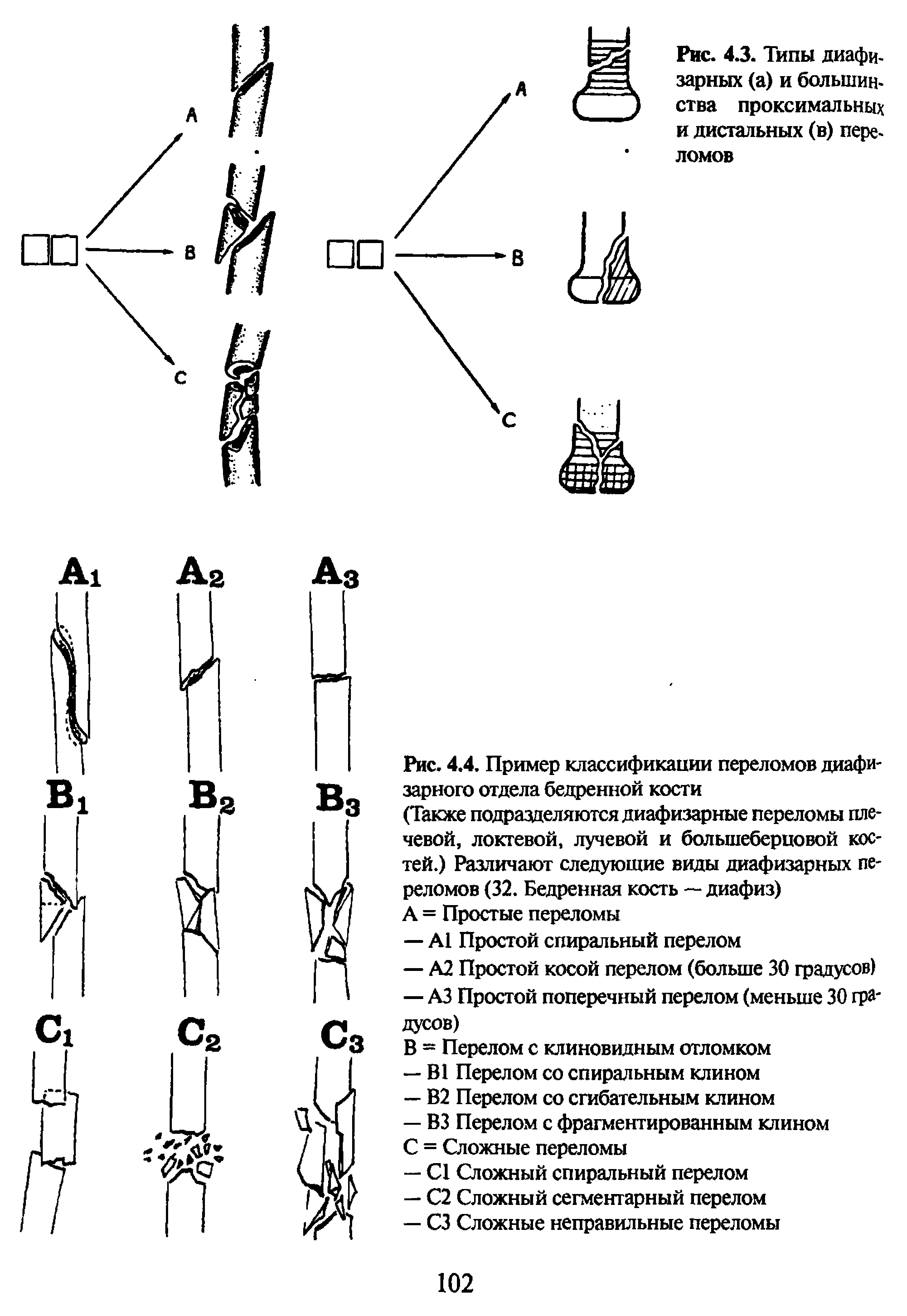 Рис. 4.4. Пример классификации переломов диафизарного отдела бедренной кости...