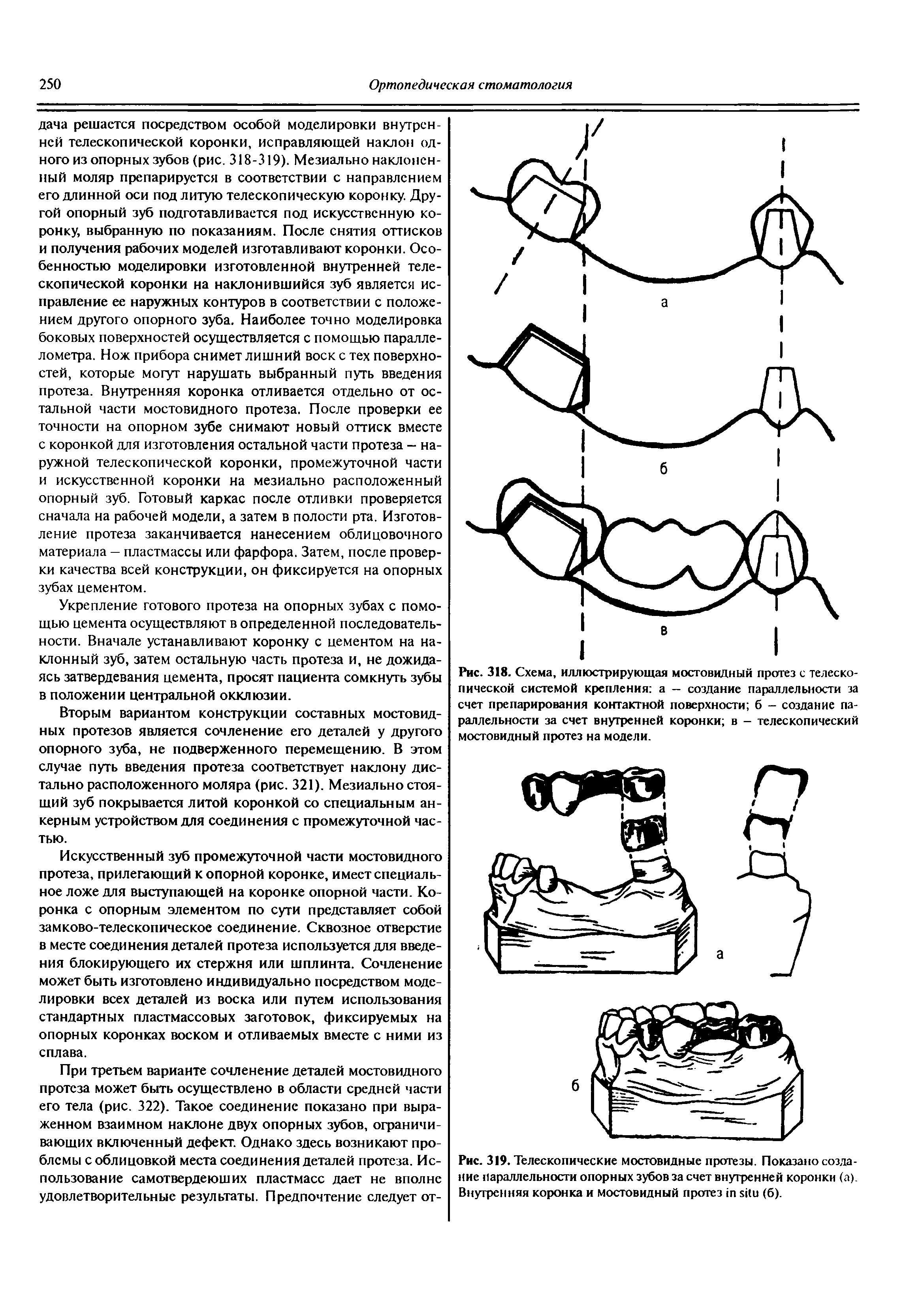 Рис. 318. Схема, иллюстрирующая мостовидный протез с телескопической системой крепления а — создание параллельности за счет препарирования контактной поверхности б — создание параллельности за счет внутренней коронки в - телескопический мостовидный протез на модели.