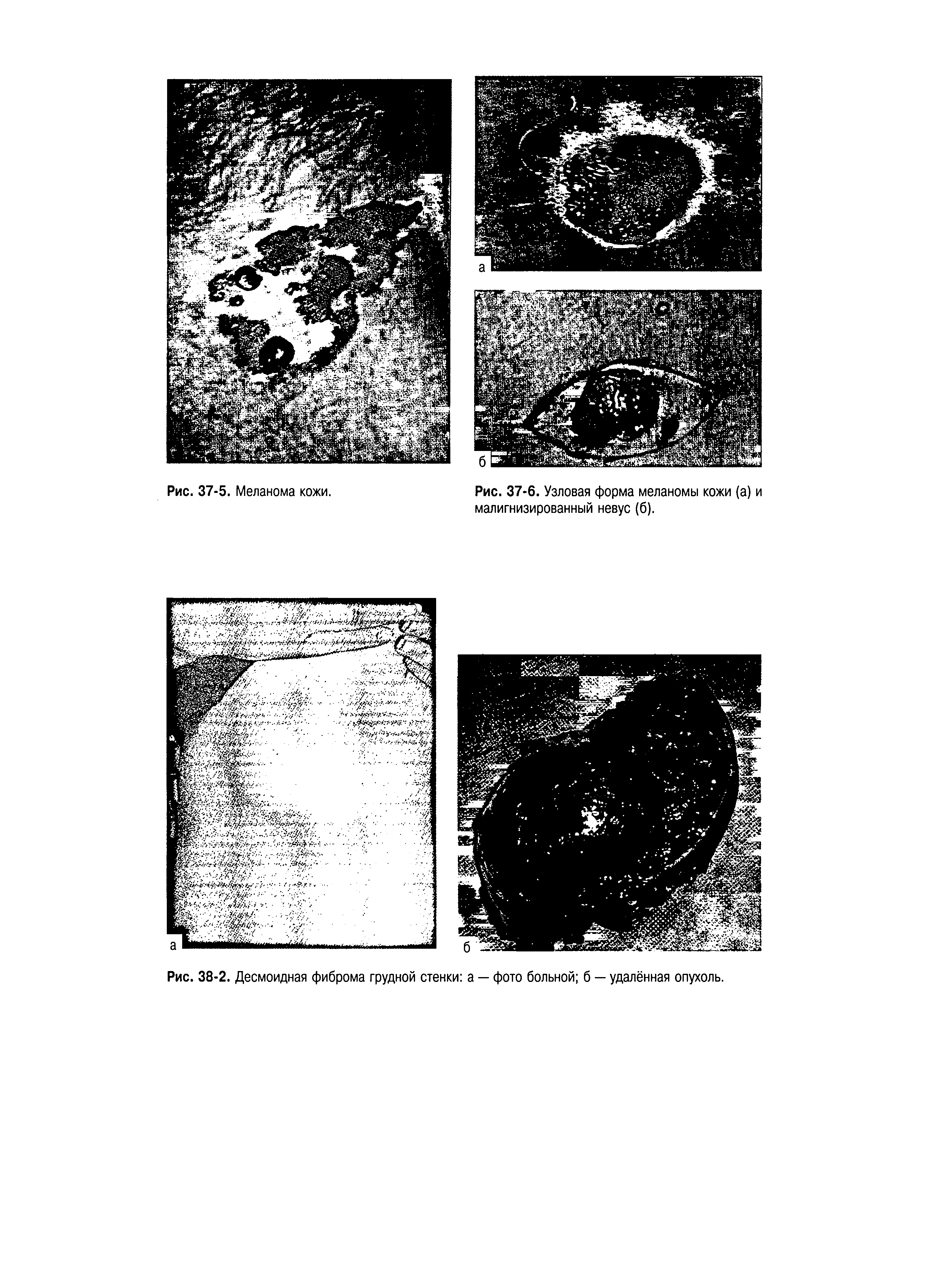 Рис. 37-6. Узловая форма меланомы кожи (а) и малигнизированный невус (б).