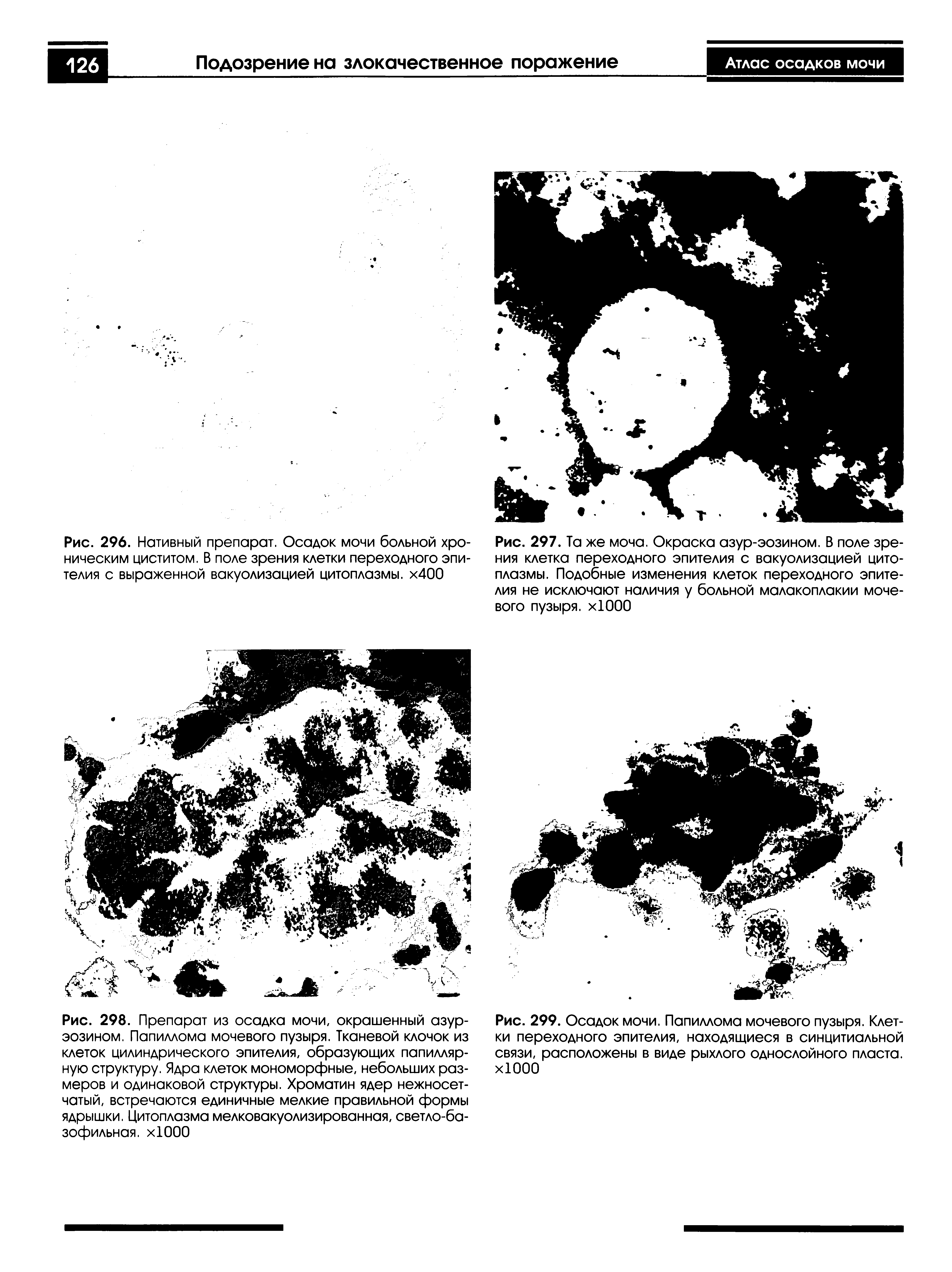 Рис. 299. Осадок мочи. Папиллома мочевого пузыря. Клетки переходного эпителия, находящиеся в синцитиальной связи, расположены в виде рыхлого однослойного пласта. хЮОО...