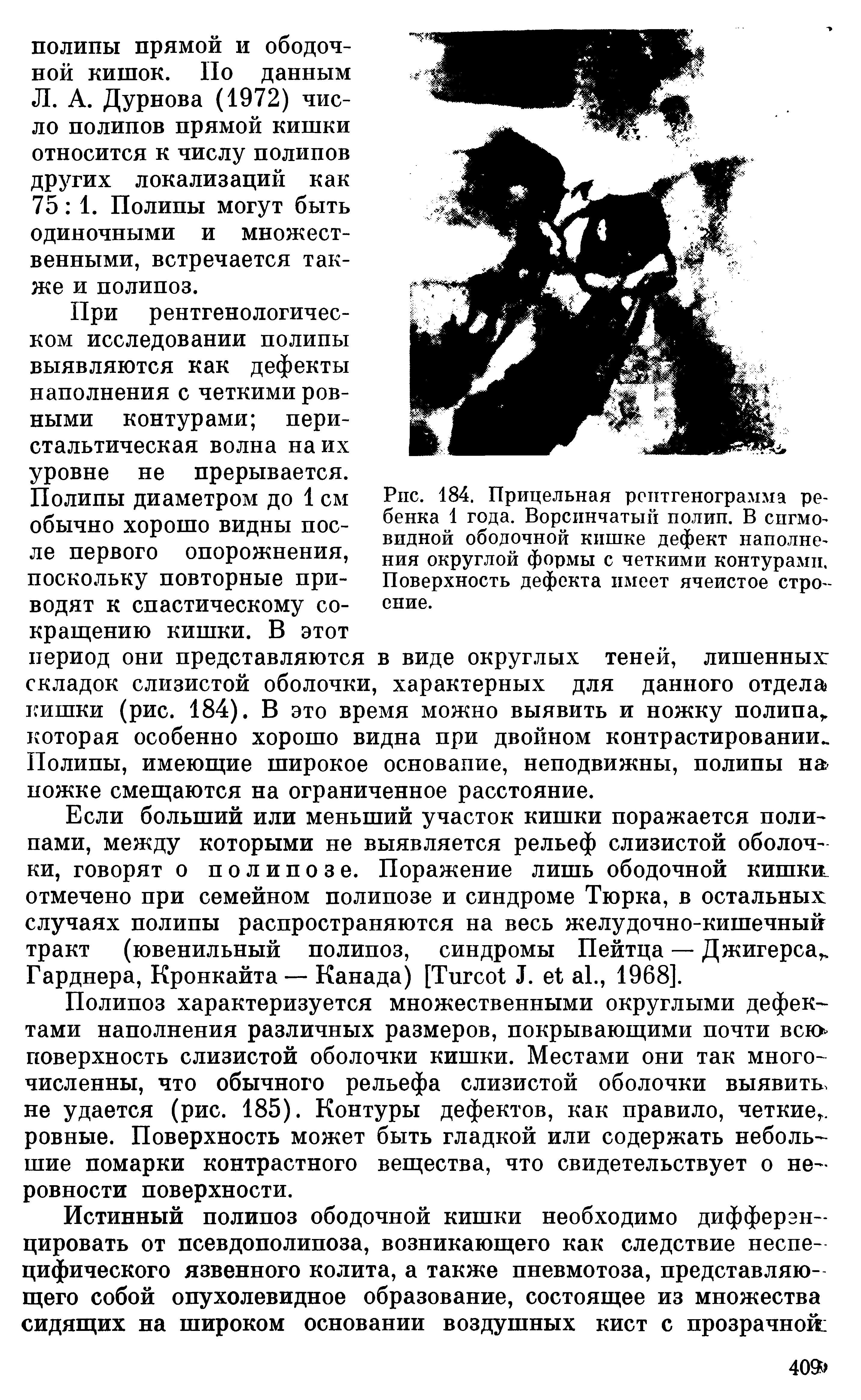 Рис. 184. Прицельная рентгенограмма ребенка 1 года. Ворсинчатый полип. В сигмовидной ободочной кишке дефект наполнения округлой формы с четкими контурами. Поверхность дефекта имеет ячеистое строение.