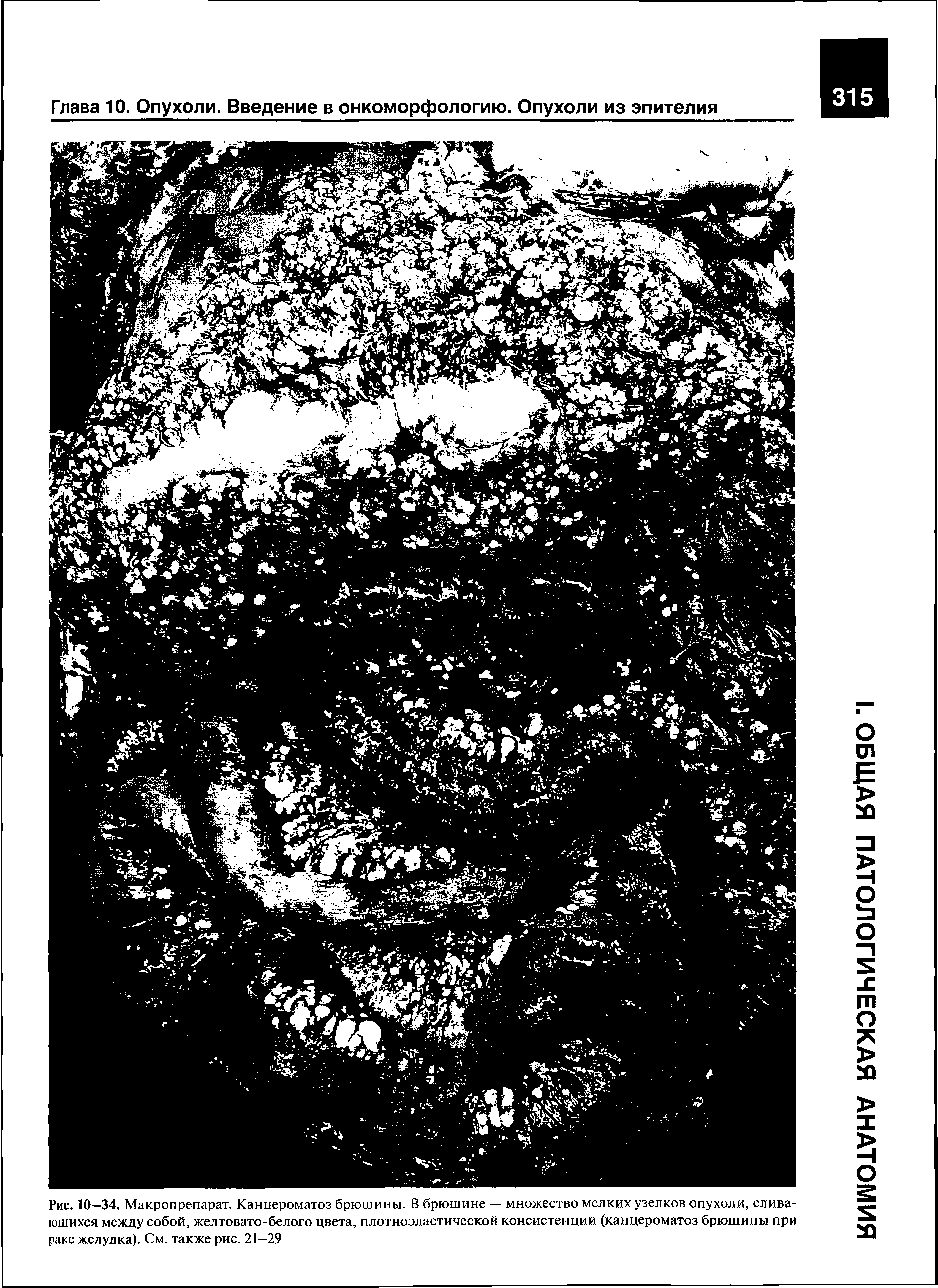 Рис. 10—34. Макропрепарат. Канцероматоз брюшины. В брюшине — множество мелких узелков опухоли, сливающихся между собой, желтовато-белого цвета, плотноэластической консистенции (канцероматоз брюшины при раке желудка). См. также рис. 21—29...