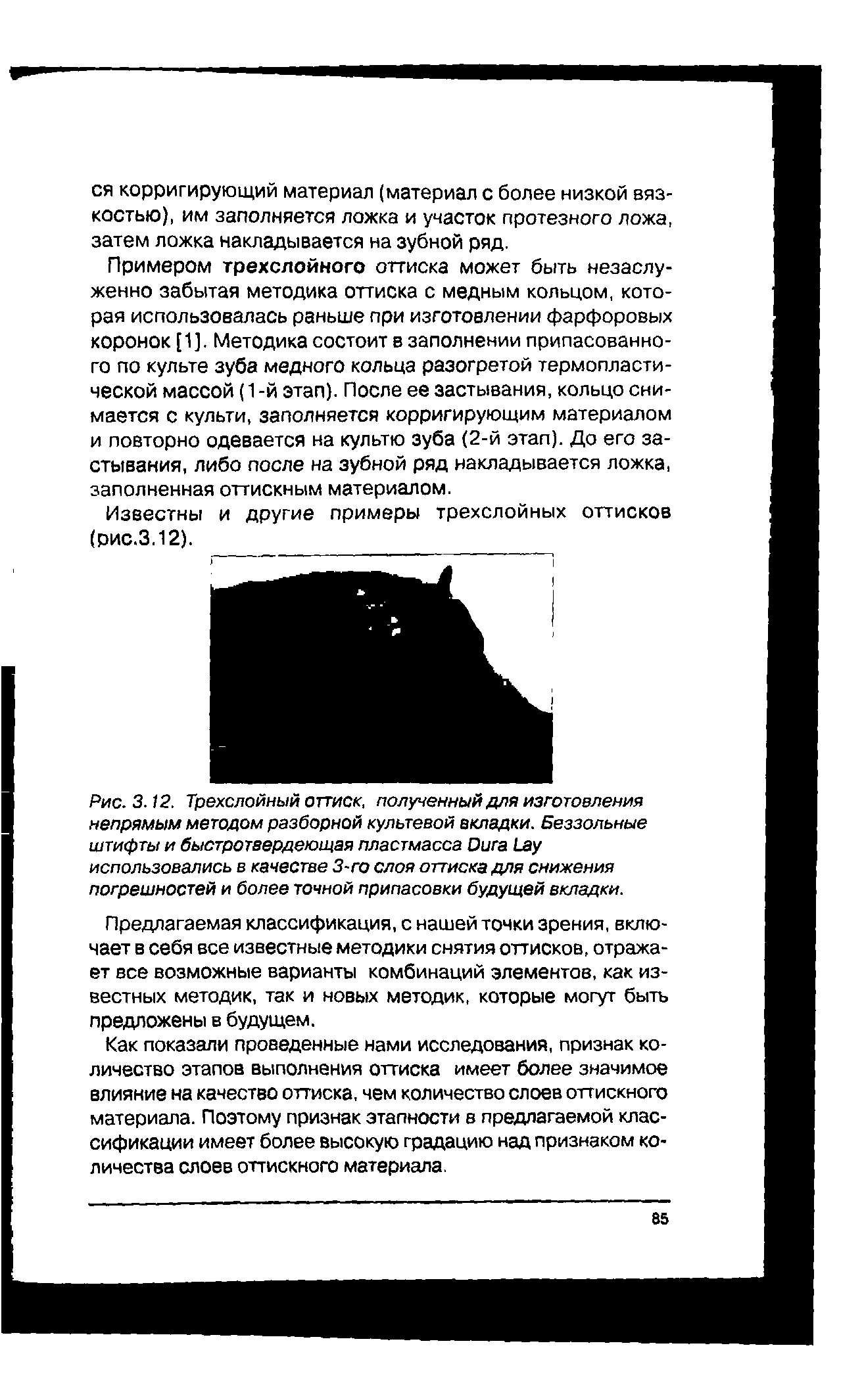 Рис. 3.12. Трехслойный оттиск, полученный для изготовления непрямым методом разборной культевой вкладки. Беззольные штифты и быстротаердеющая пластмасса D L использовались в качестве 3-го слоя оттиска для снижения погрешностей и более точной припасовки будущей вкладки.