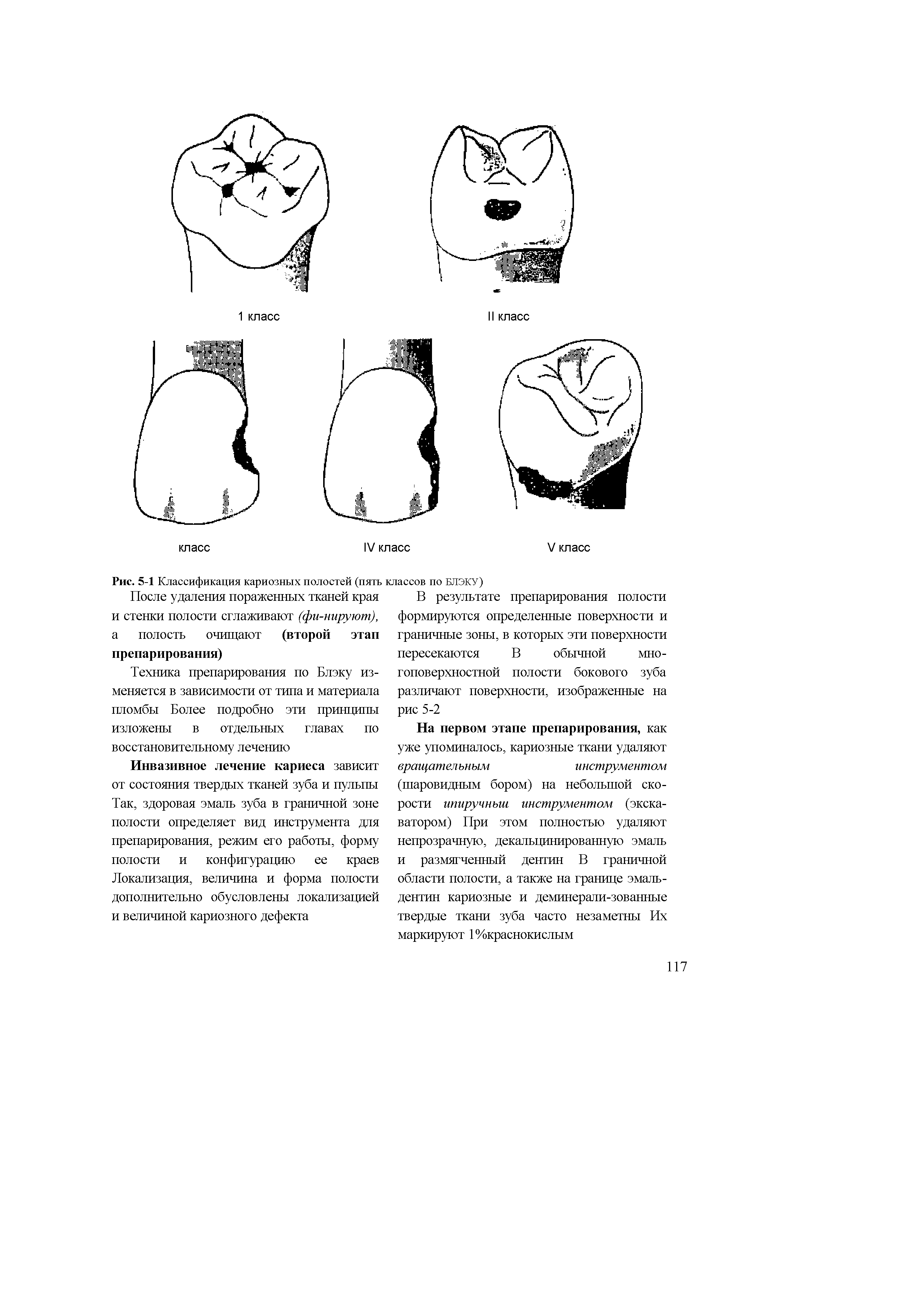 Рис. 5-1 Классификация кариозных полостей (пять классов по БЛЭКУ)...