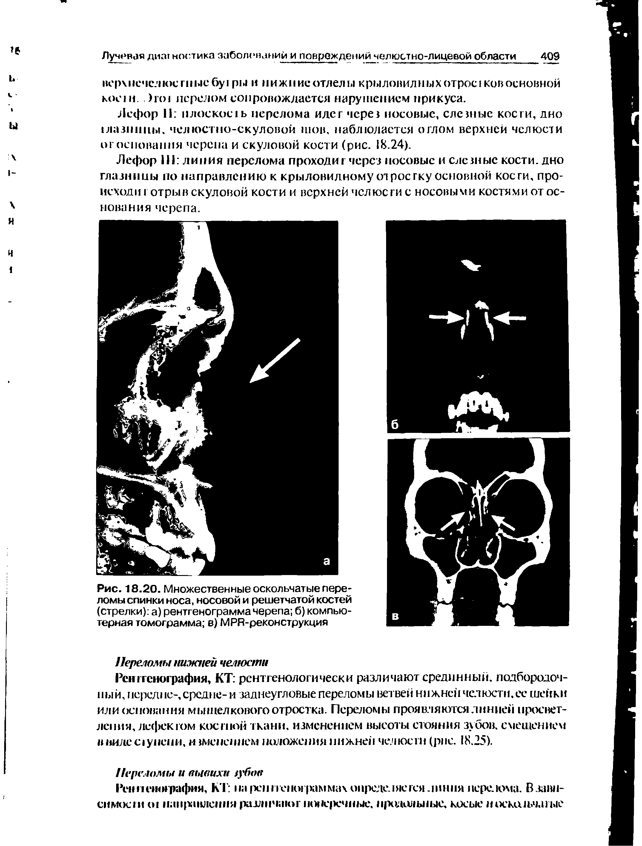 Рис. 18.20. Множественные оскольчатые переломы спинки носа, носовой и решетчатой костей (стрелки) а) рентгенограмма черепа б) компьютерная томограмма в) МРЯ-реконструкция...