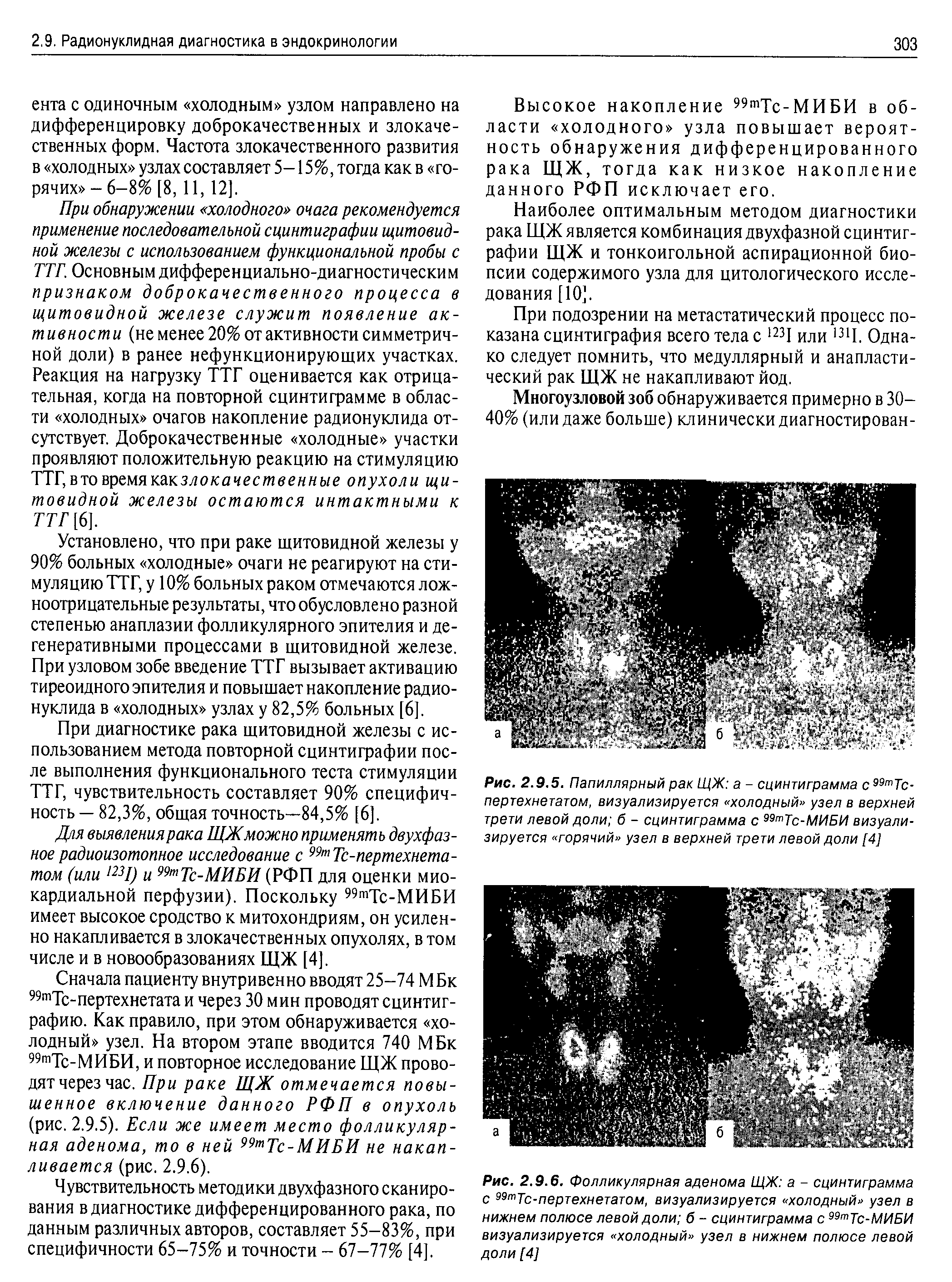 Рис. 2.9.5. Папиллярный рак ЩЖ а - сцинтиграмма с 99тТс-пертехнетатом, визуализируется холодный узел в верхней трети левой доли б - сцинтиграмма с 99тТс-МИБИ визуализируется горячий узел в верхней трети левой доли [4]...