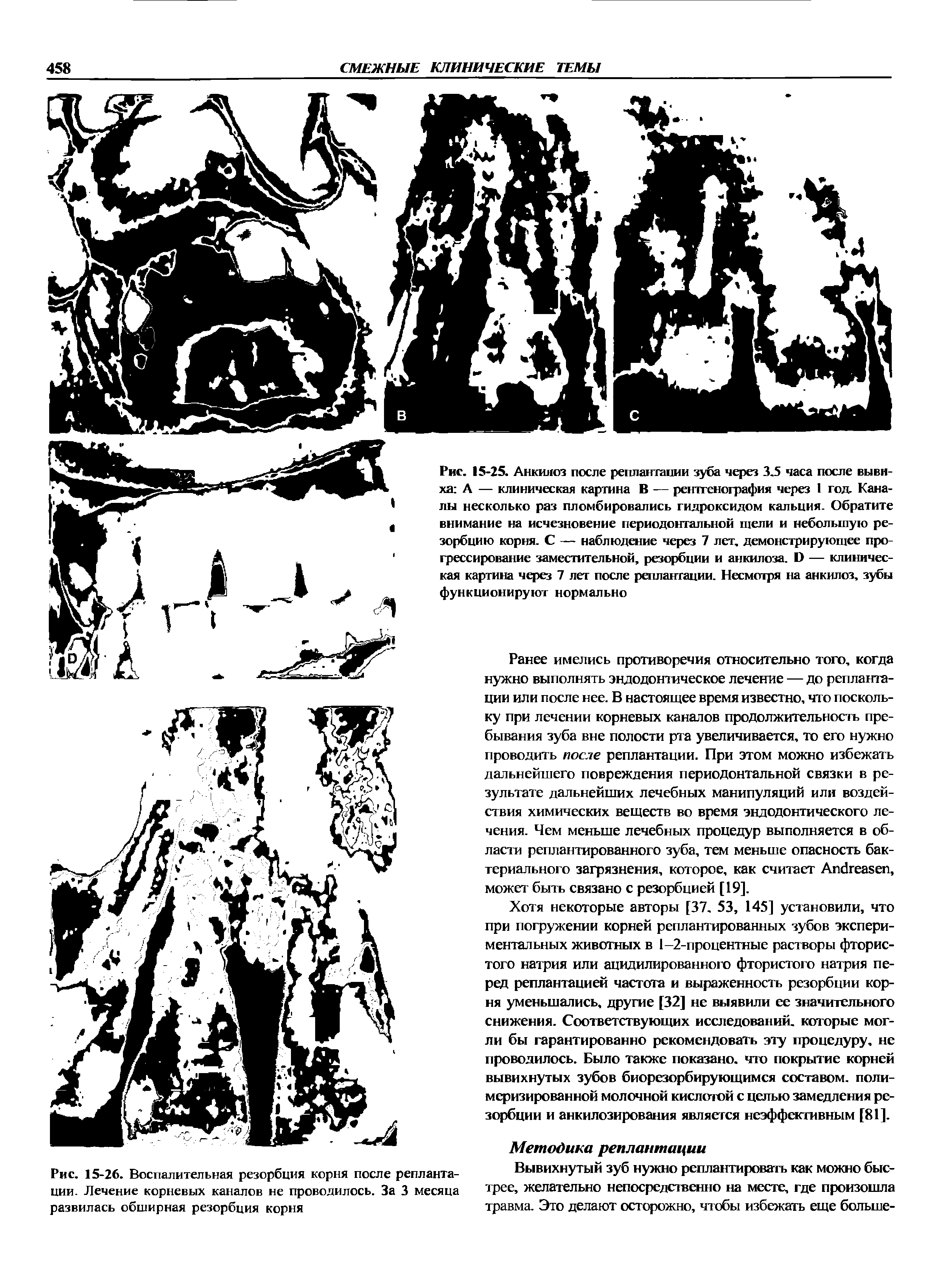 Рис. 15-26. Воспалительная резорбция корня после реплантации. Лечение корневых каналов не проводилось. За 3 месяца развилась обширная резорбция корня...