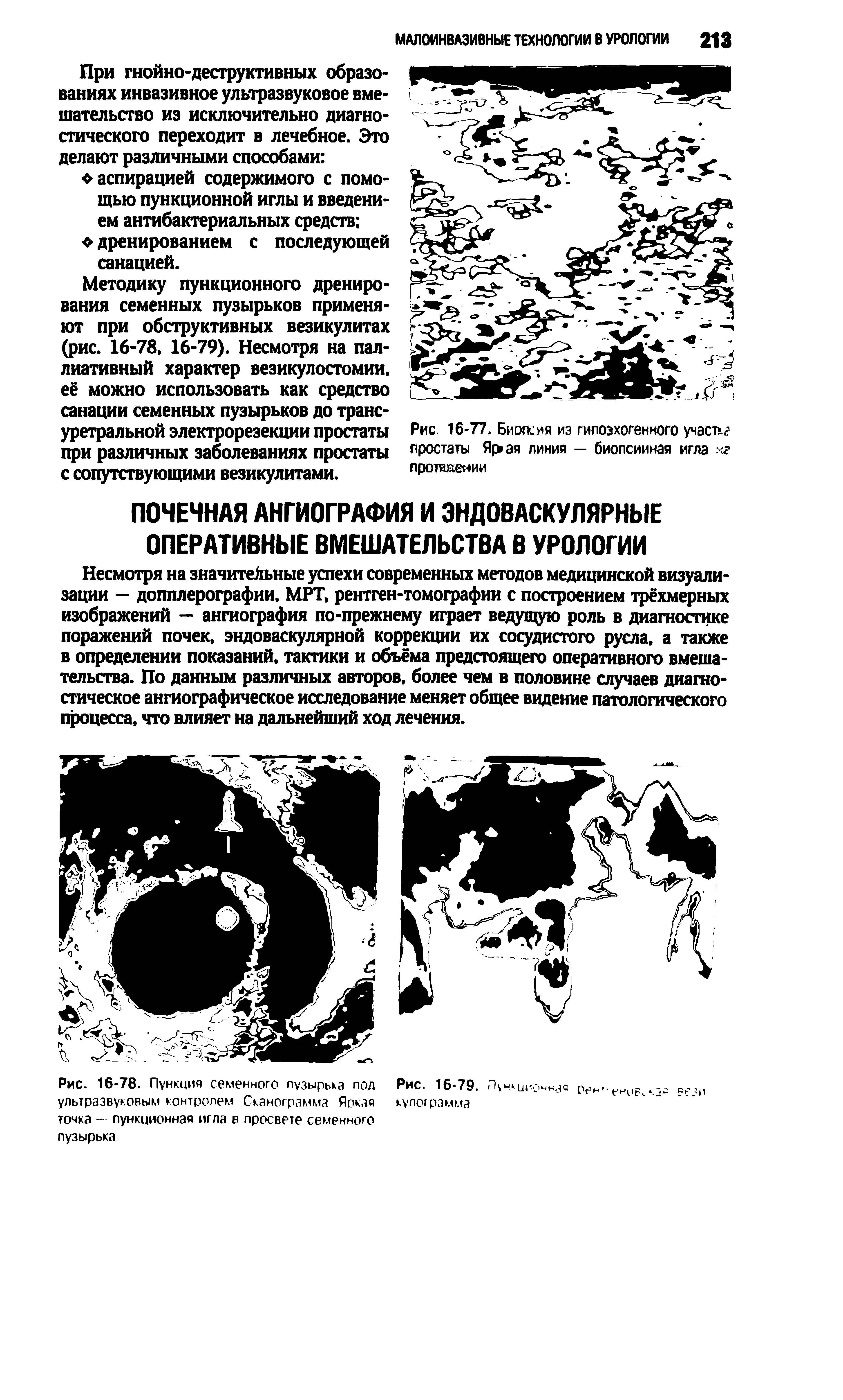 Рис. 16-78. Пункция семенного пузырька пол ультразвуковым контролем Сканограмма Яокэя...