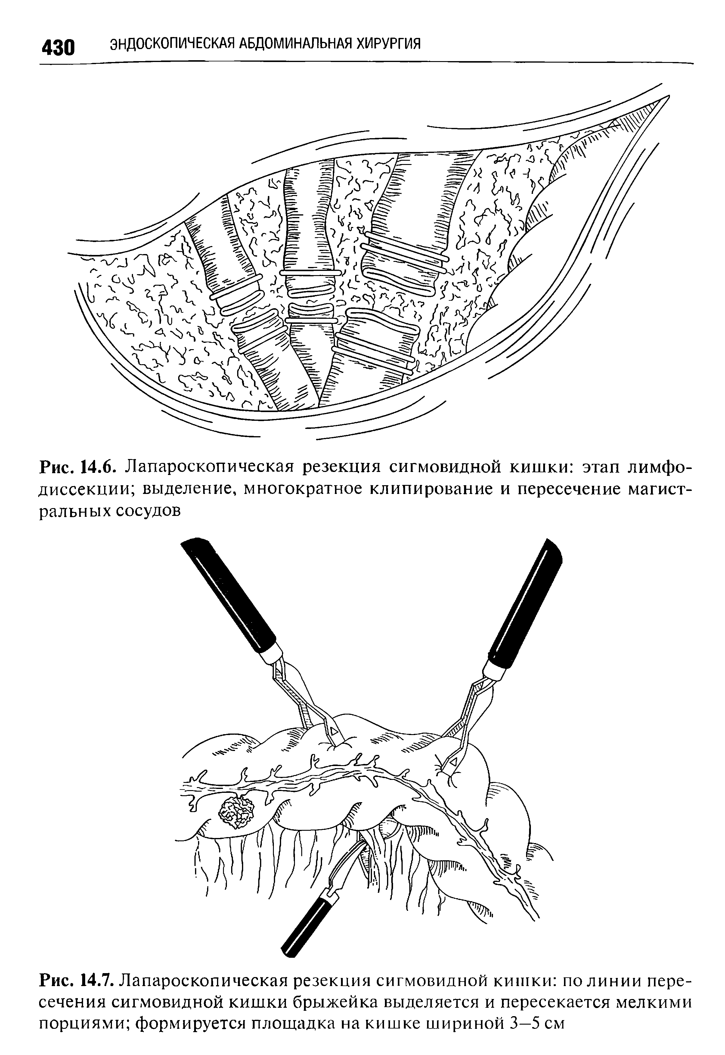 Рис. 14.7. Лапароскопическая резекция сигмовидной кишки по линии пересечения сигмовидной кишки брыжейка выделяется и пересекается мелкими порциями формируется площадка на кишке шириной 3—5 см...
