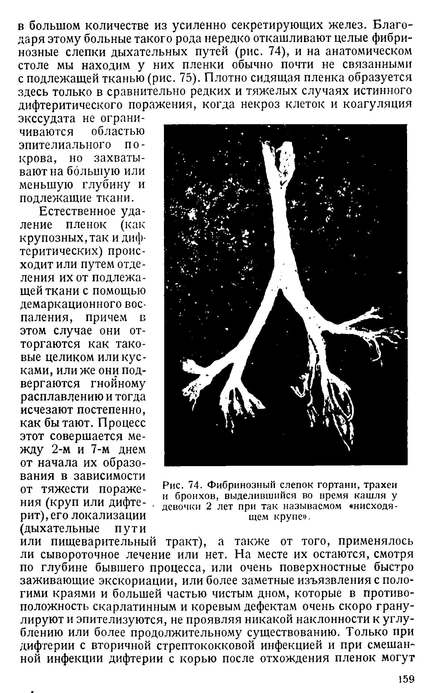 Рис. 74. Фибринозный слепок гортани, трахеи и бронхов, выделившийся во время кашля у девочки 2 лет при так называемом нисходящем крупе .