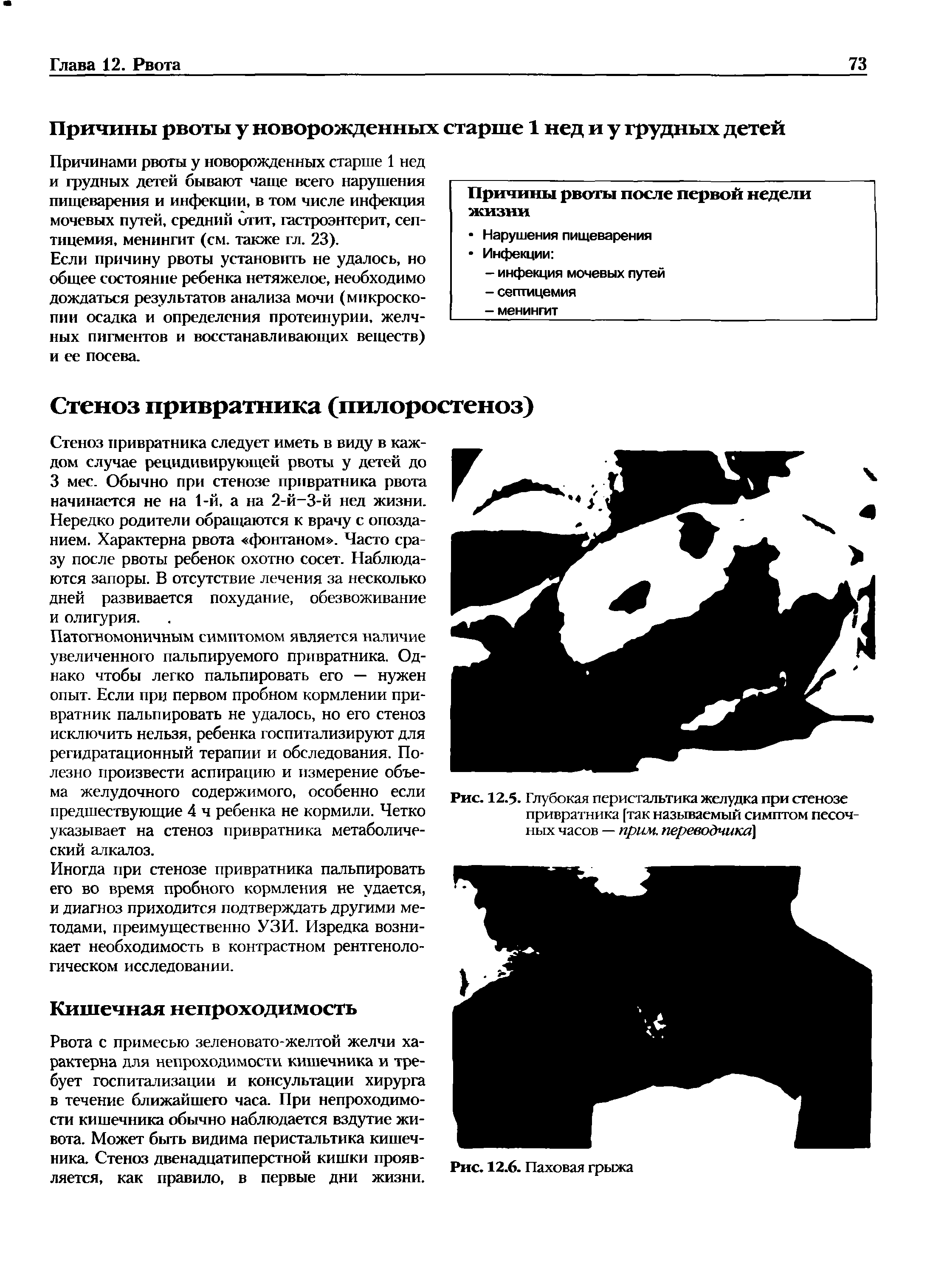 Рис. 12.5. Глубокая перистальтика желудка при стенозе привратника [так называемый симптом песочных часов — прим, переводчике ...