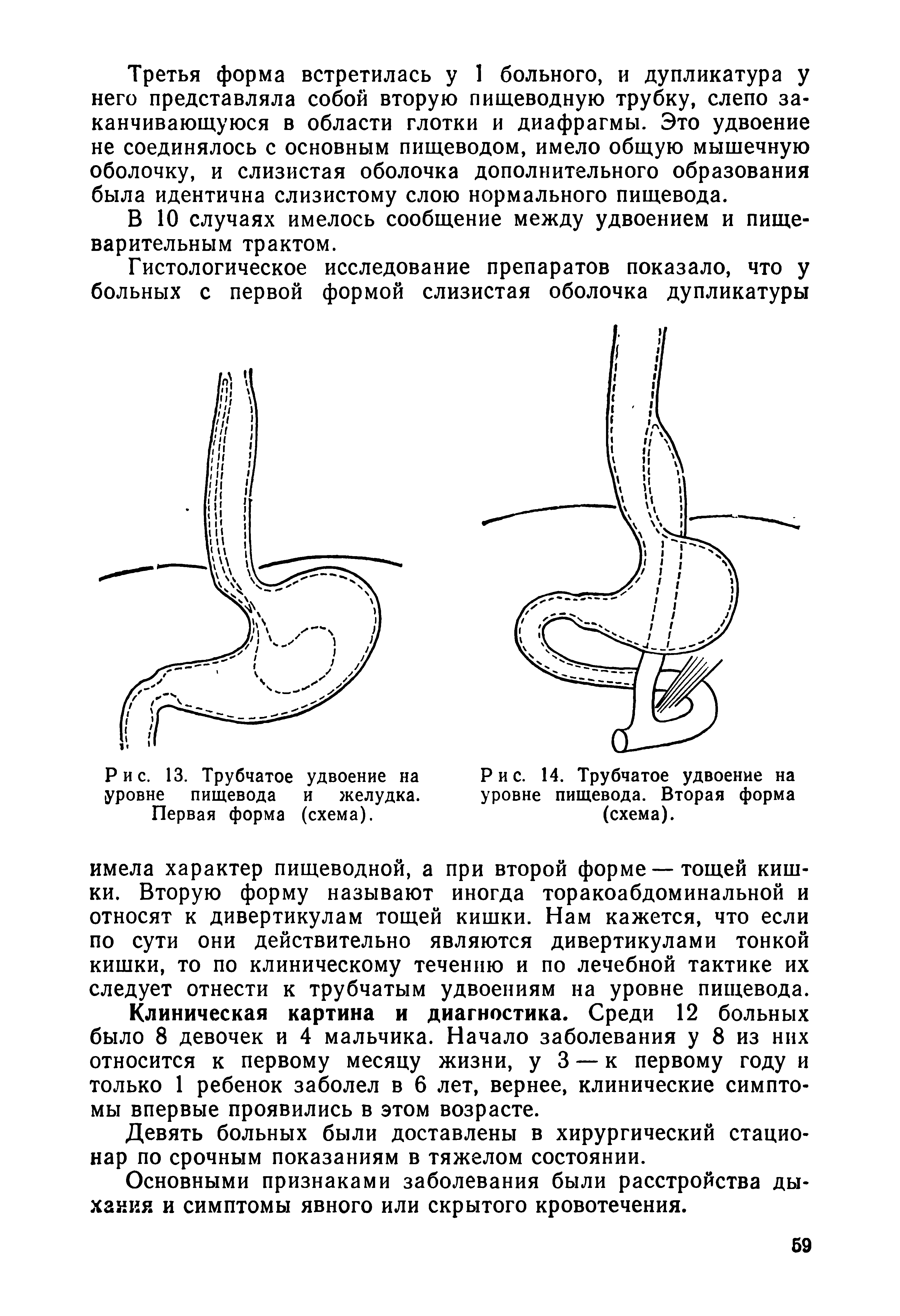 Рис. 14. Трубчатое удвоение на уровне пищевода. Вторая форма (схема).