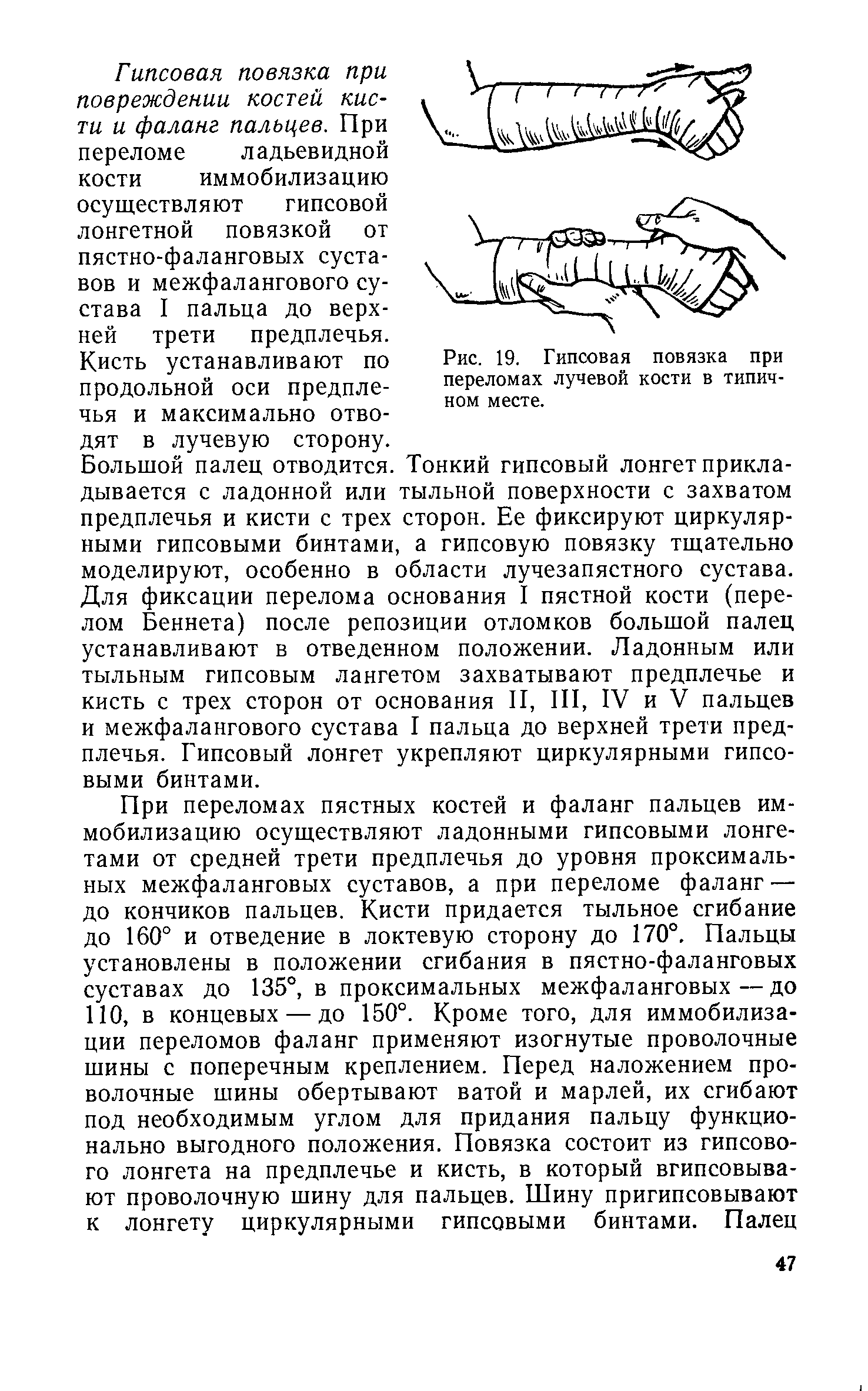 Рис. 19. Гипсовая повязка при переломах лучевой кости в типичном месте.