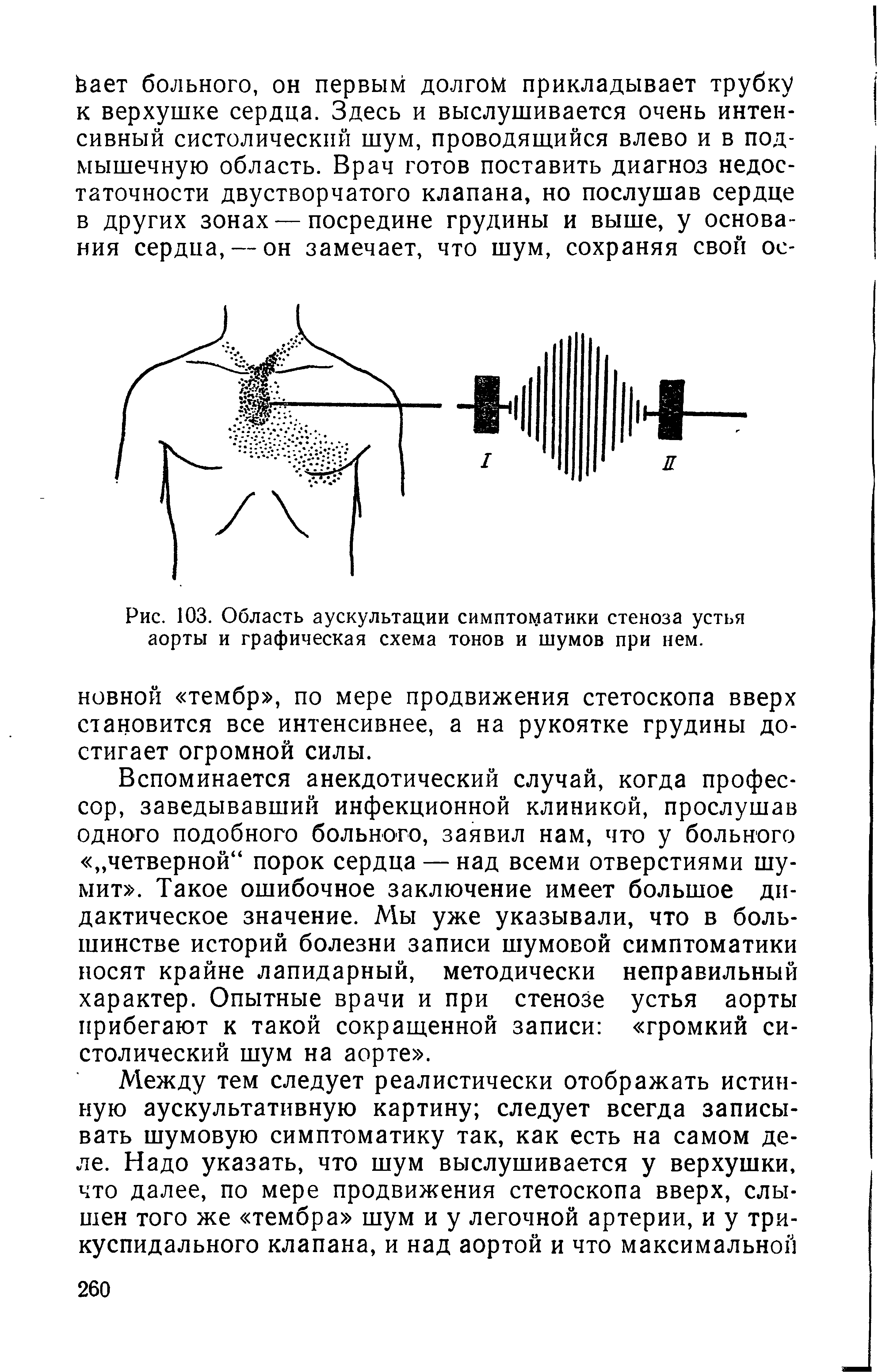 Рис. 103. Область аускультации симптоматики стеноза устья аорты и графическая схема тонов и шумов при нем.