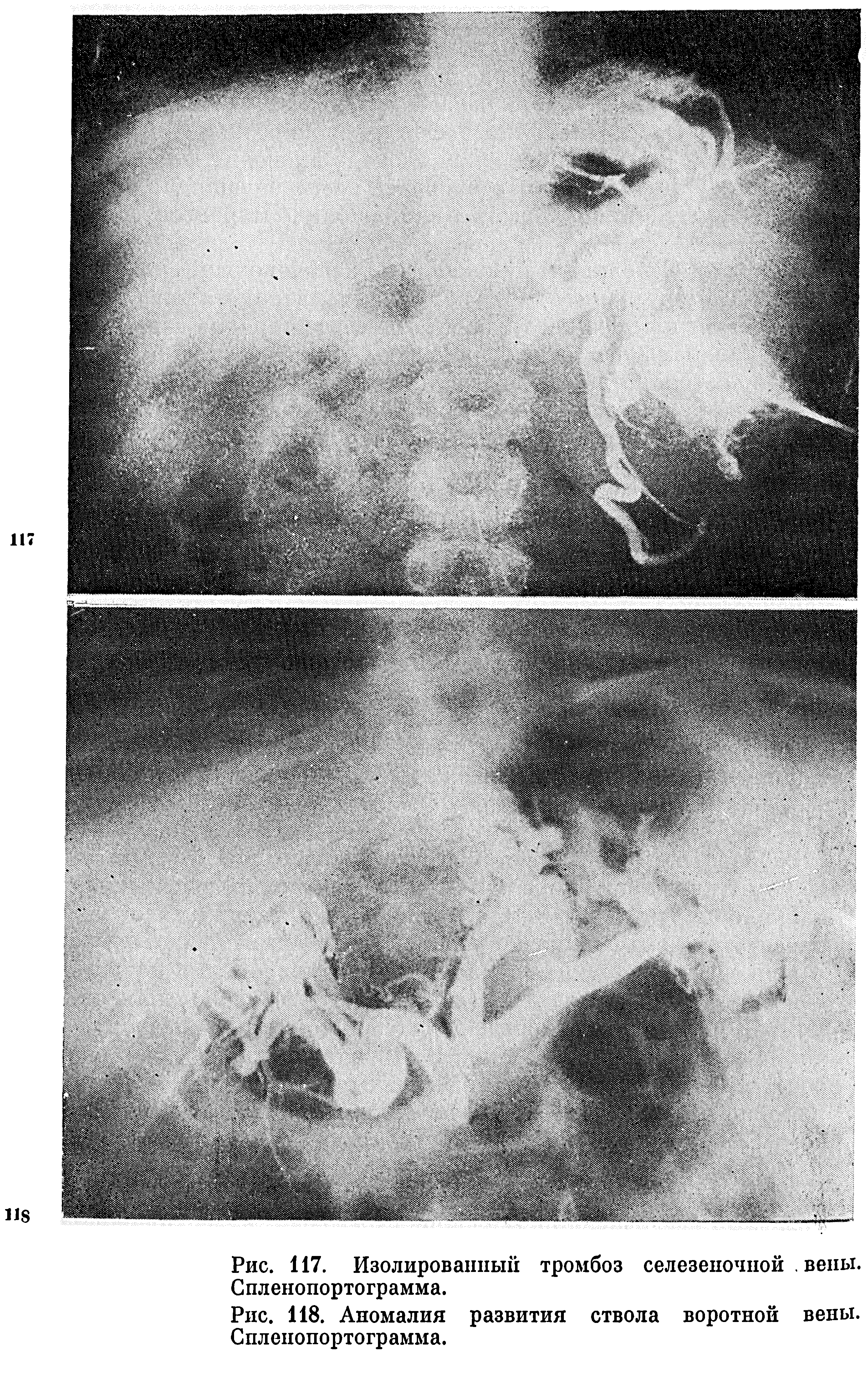 Рис. 118. Аномалия развития ствола воротной вены. Спленопортограмма.