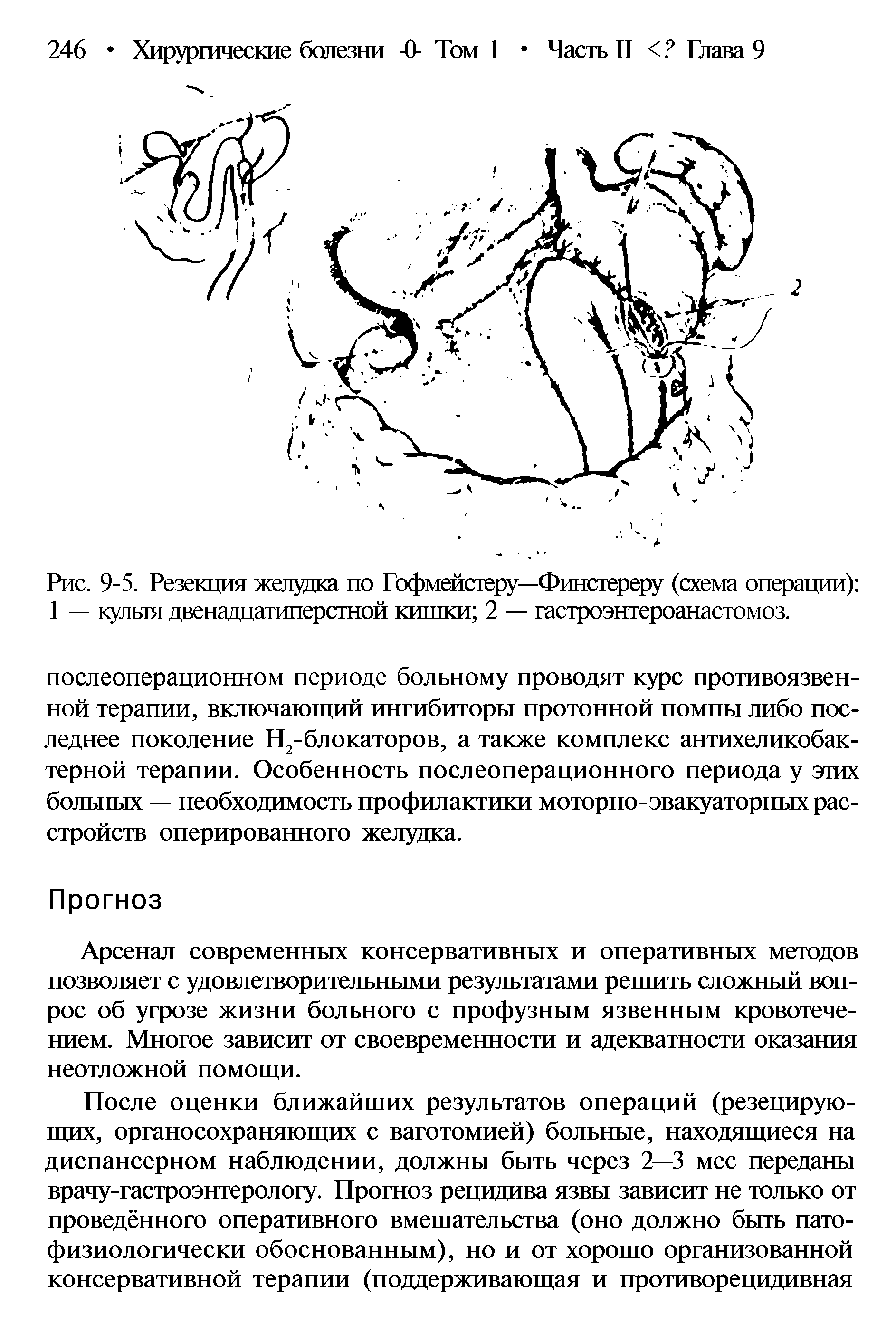 Рис. 9-5. Резекция желудка по Гофмейстеру—Финстереру (схема операции) ...