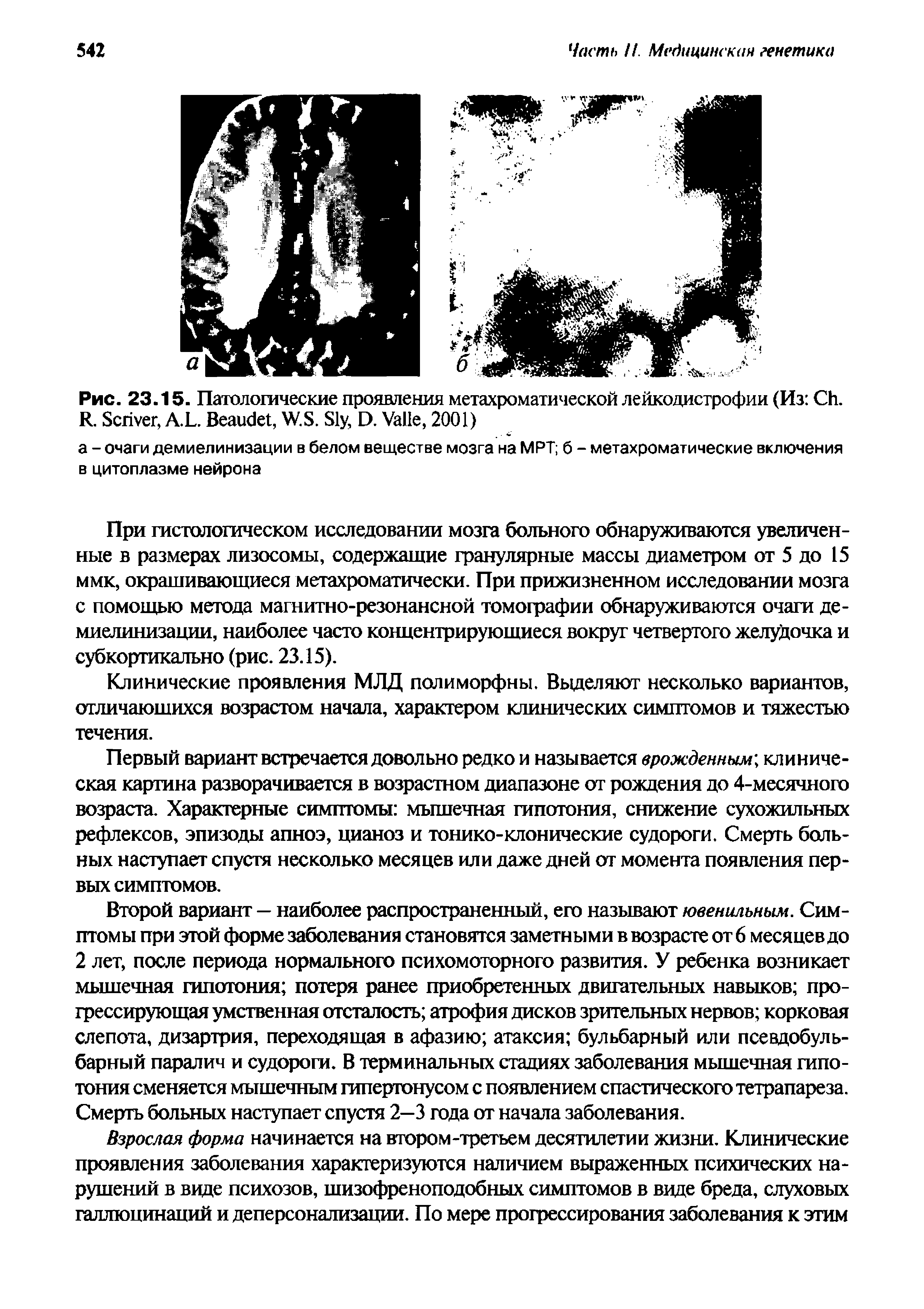 Рис. 23.15. Патологические проявления метахроматической лейкодистрофии (Из C . R. S , A.L. B , W.S. S , D. V , 2001)...