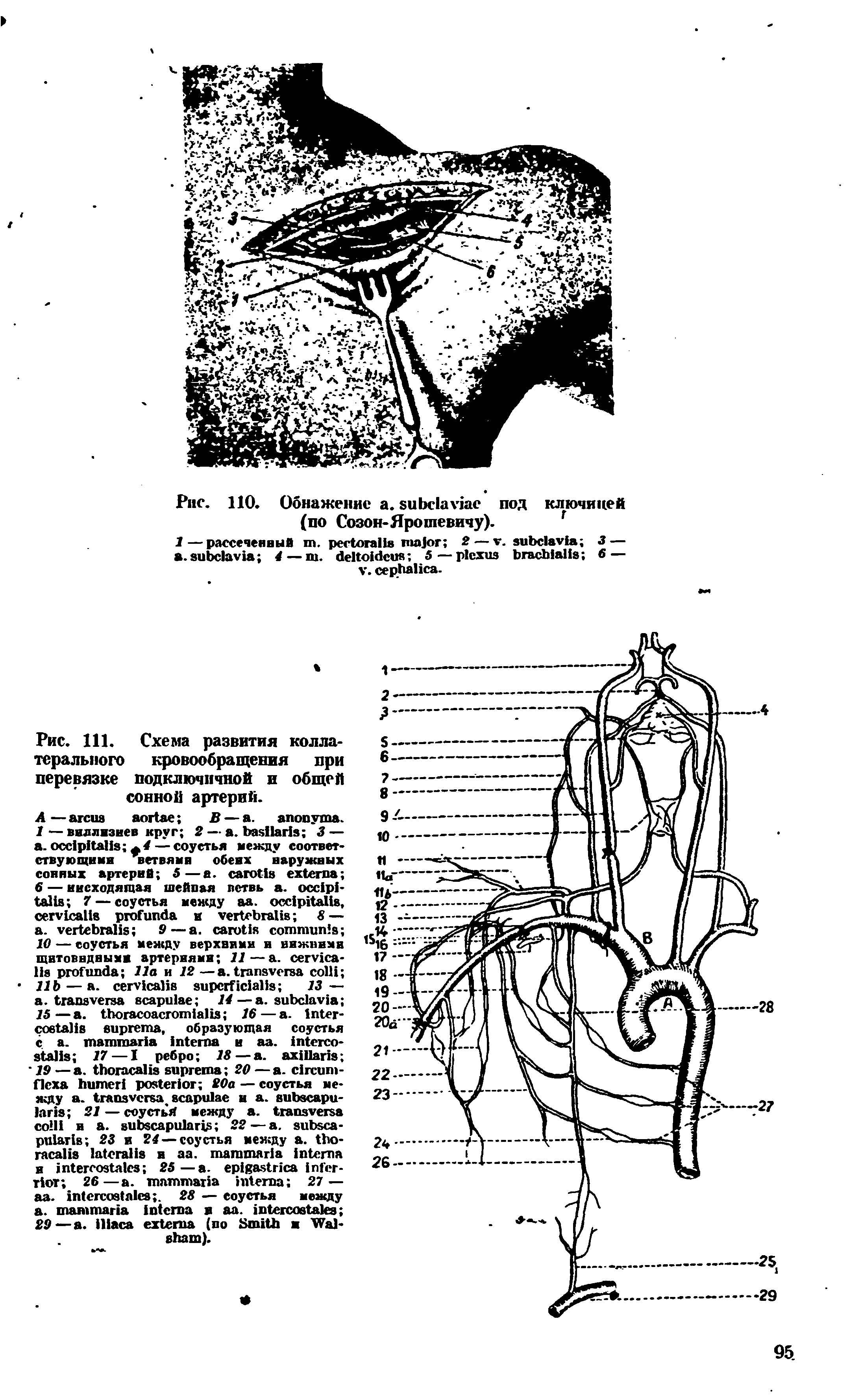 Рис. 111. Схема развития коллатерального кровообращения при перевязке подключичной и общей сонной артерий.