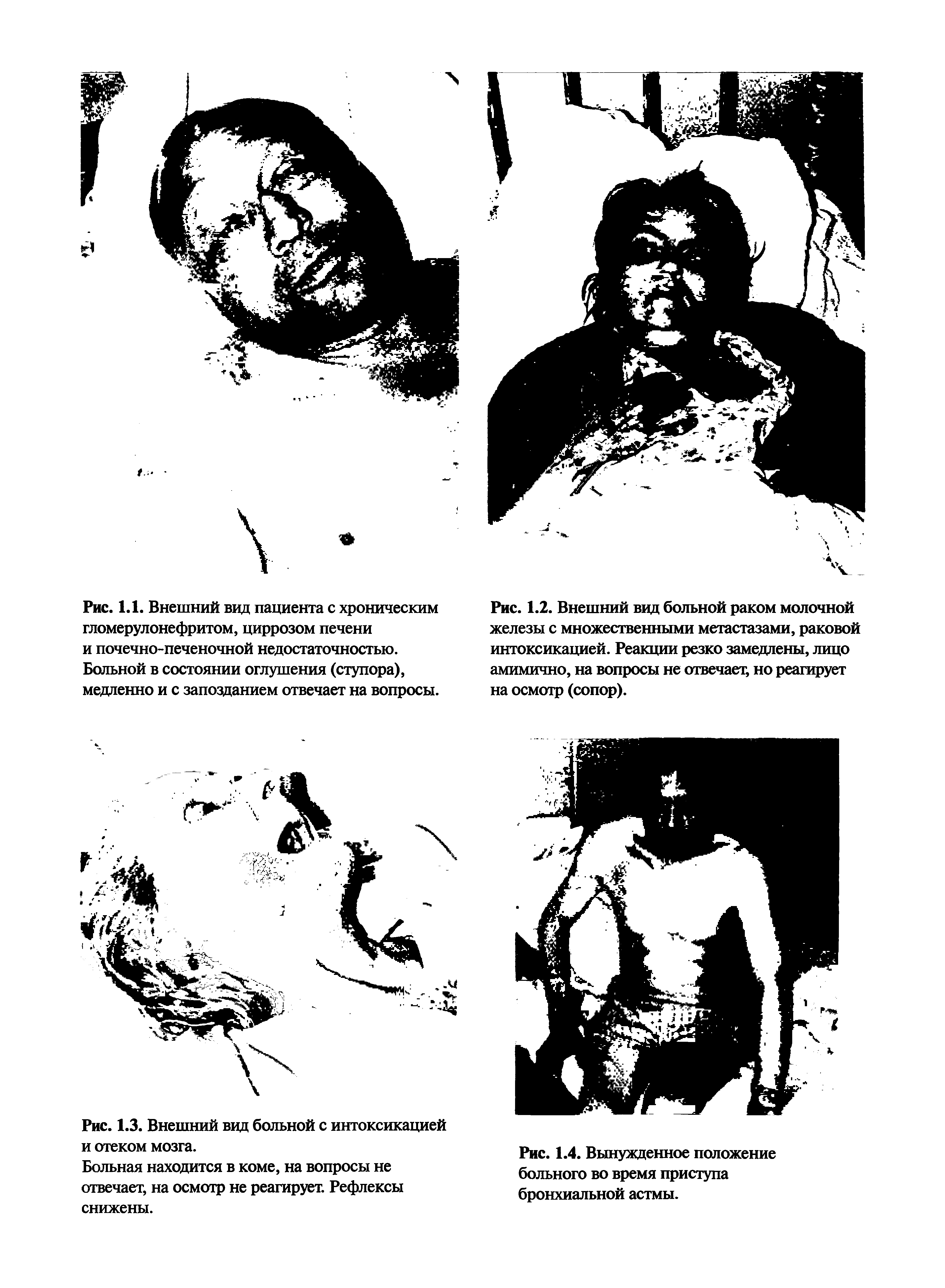 Рис. 1.2. Внешний вид больной раком молочной железы с множественными метастазами, раковой интоксикацией. Реакции резко замедлены, лицо амимично, на вопросы не отвечает, но реагирует на осмотр (сопор).