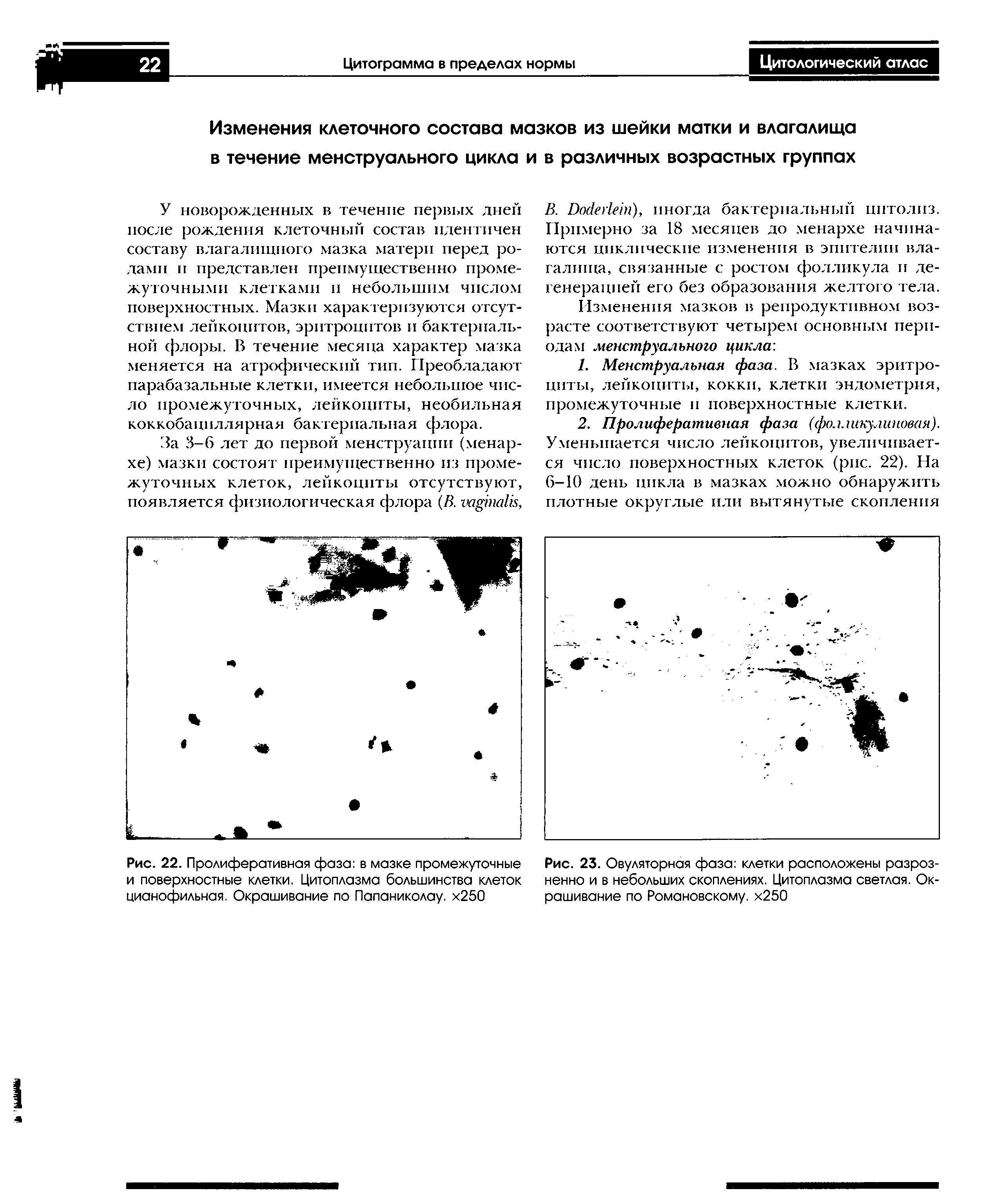 Рис. 23. Овуляторная фаза клетки расположены разрозненно и в небольших скоплениях. Цитоплазма светлая. Окрашивание по Романовскому. х250...