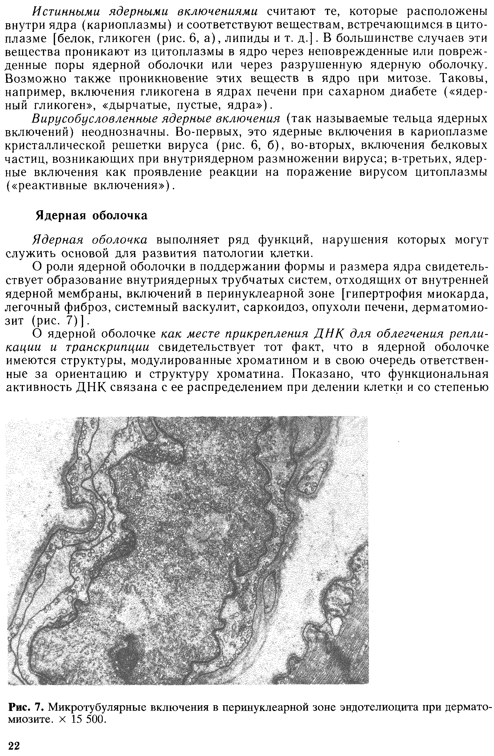 Рис. 7. Микротубулярные включения в перинуклеарной зоне эндотелиоцита при дерматомиозите. х 15 500.