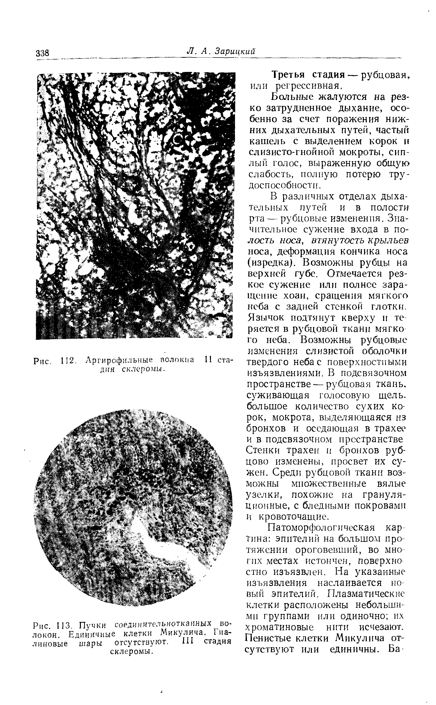 Рис. 113. Пучки соединительнотканных волокон. Единичные клетки Микулича. Гиалиновые шары отсутствуют. III стадия склеромы.