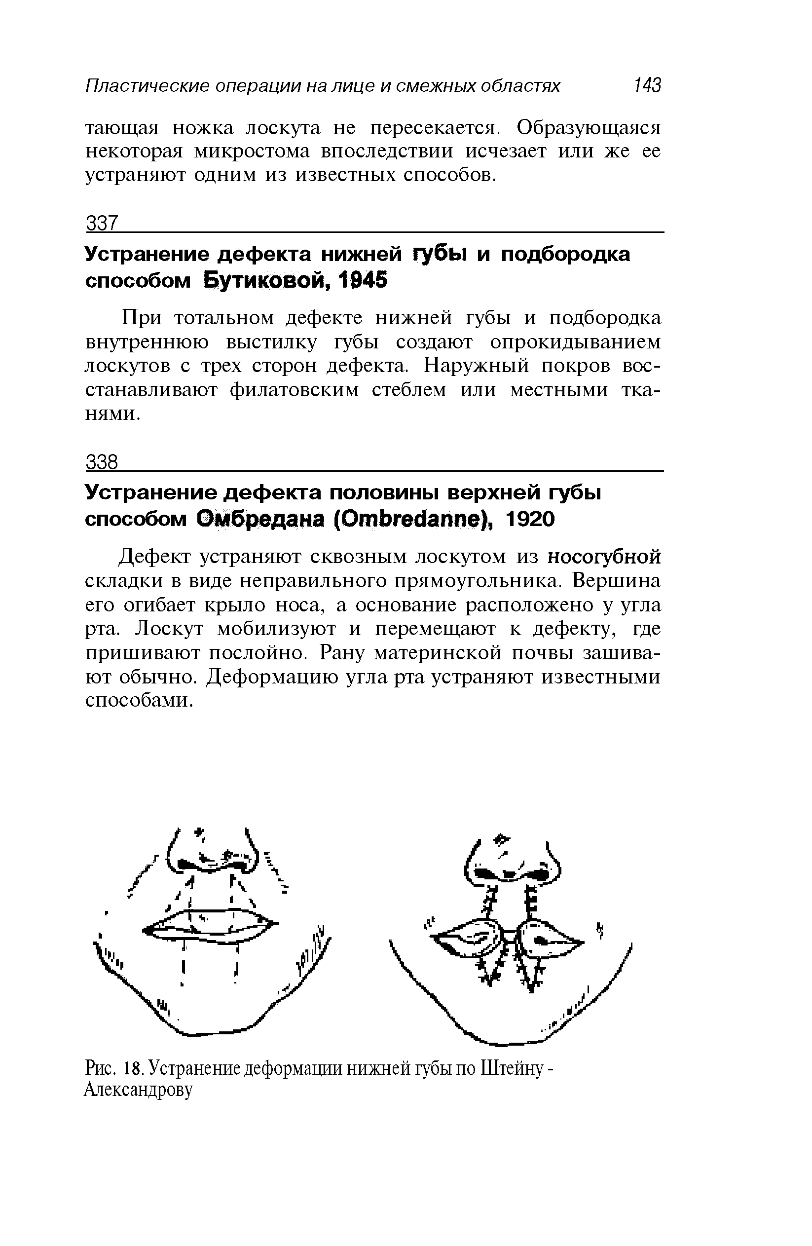 Рис. 18. Устранение деформации нижней губы по Штейну -Александрову...