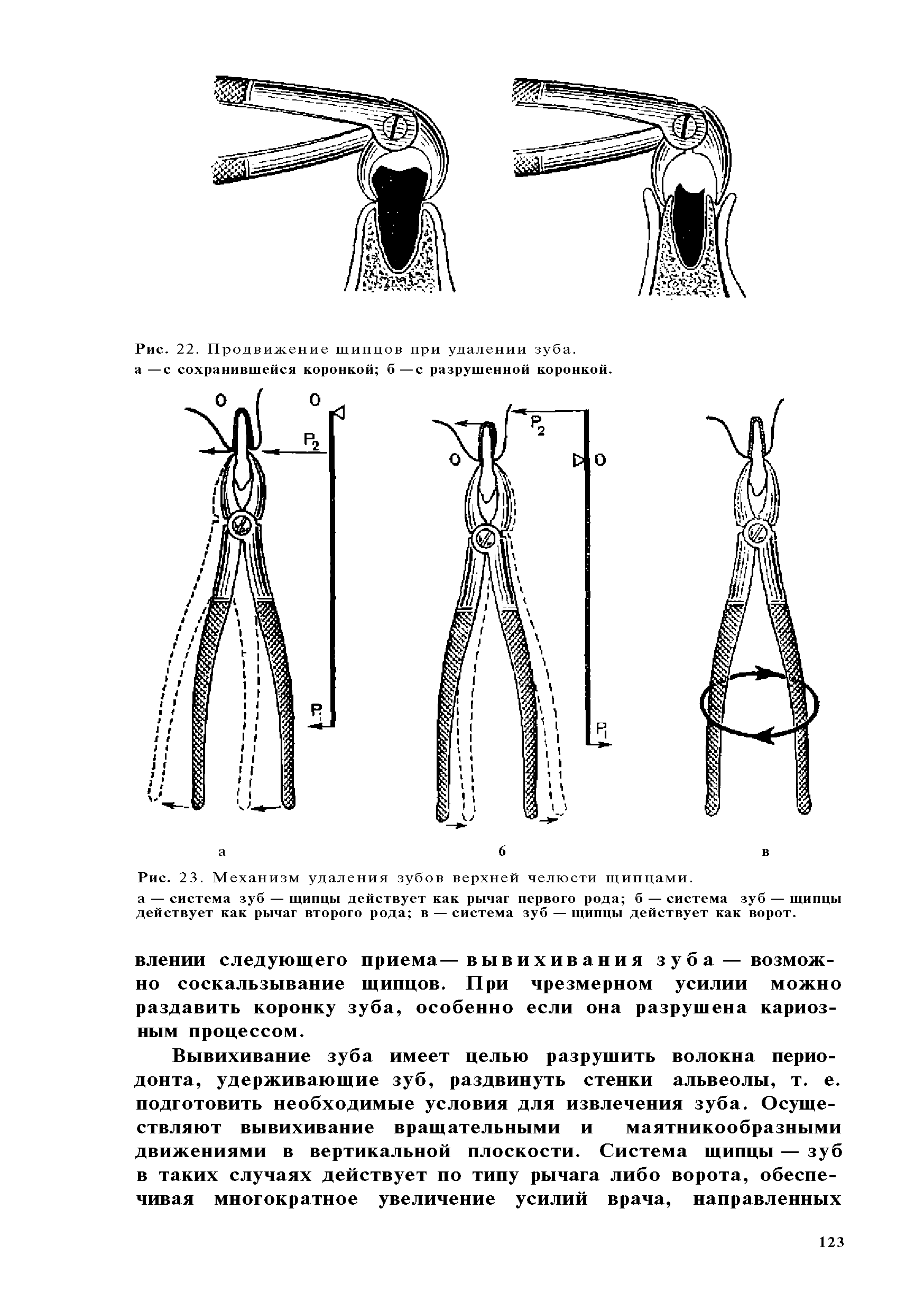 Рис. 22. Продвижение щипцов при удалении зуба, а —с сохранившейся коронкой б —с разрушенной коронкой.