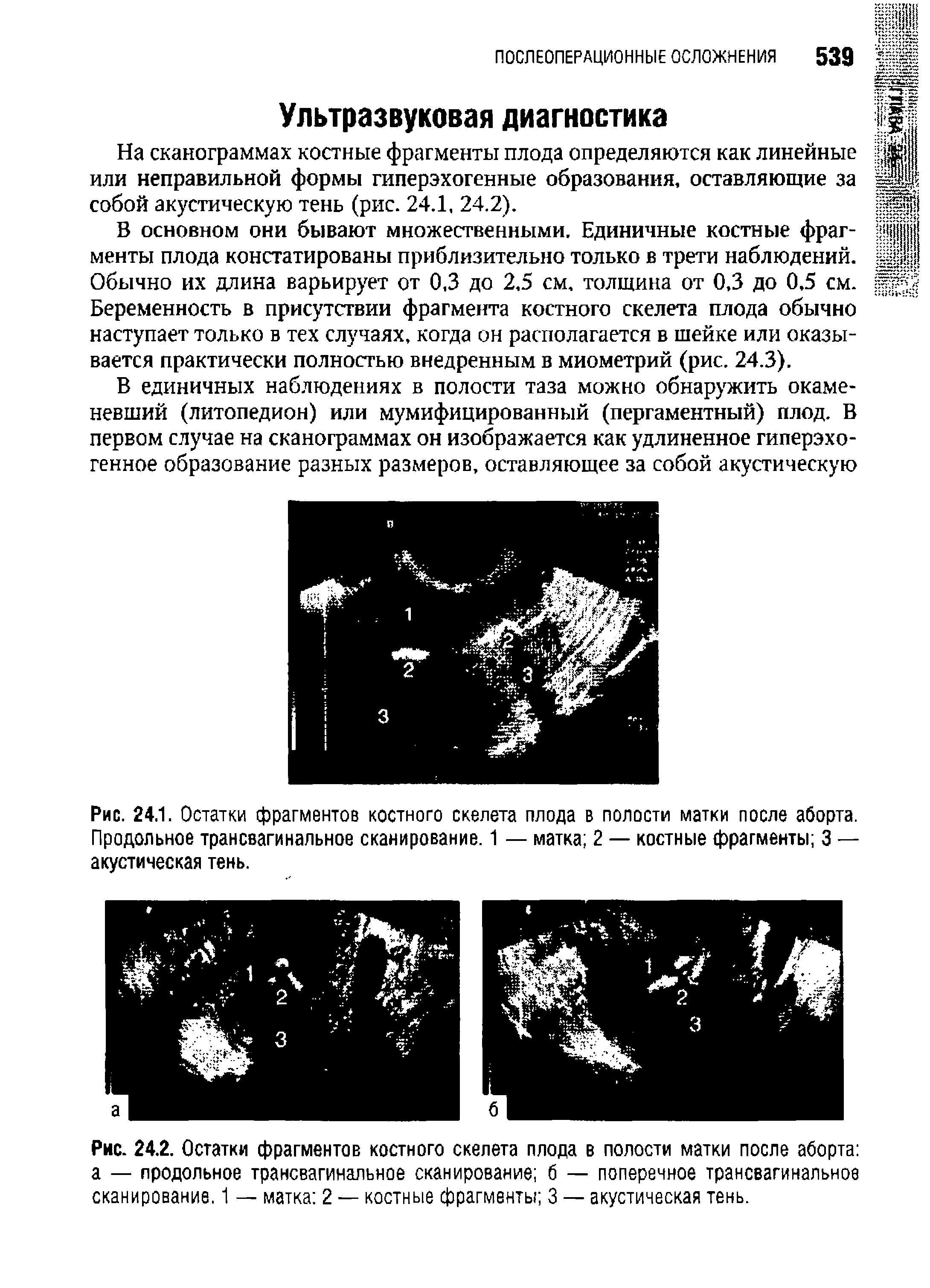 Рис. 24.1. Остатки фрагментов костного скелета плода в полости матки после аборта. Продольное трансвагинальное сканирование. 1 — матка 2 — костные фрагменты 3 — акустическая тень.