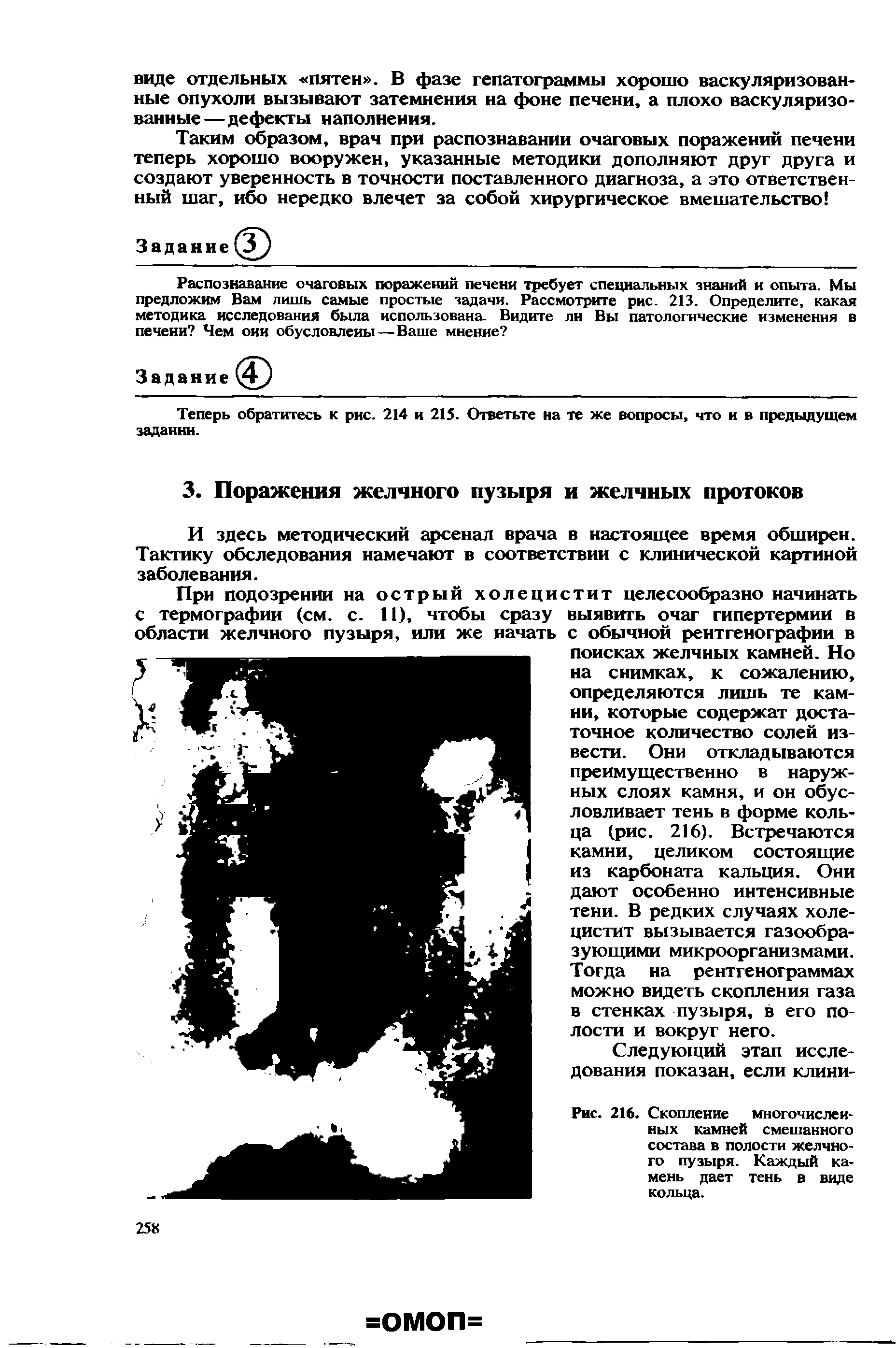 Рис. 216. Скопление многочисленных камней смешанного состава в полости желчного пузыря. Каждый камень дает тень в виде кольца.