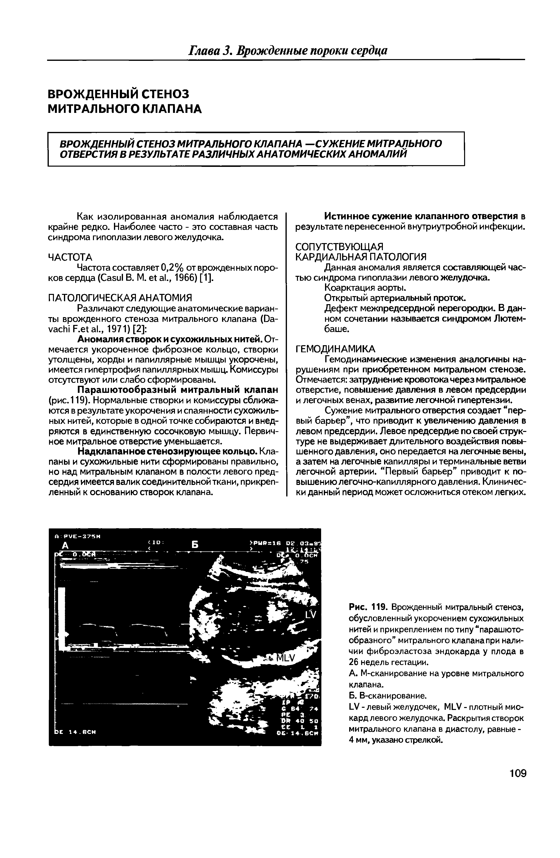 Рис. 119. Врожденный митральный стеноз, обусловленный укорочением сухожильных нитей и прикреплением по типу парашютообразного митрального клапана при наличии фиброэластоза эндокарда у плода в 26 недель гестации.