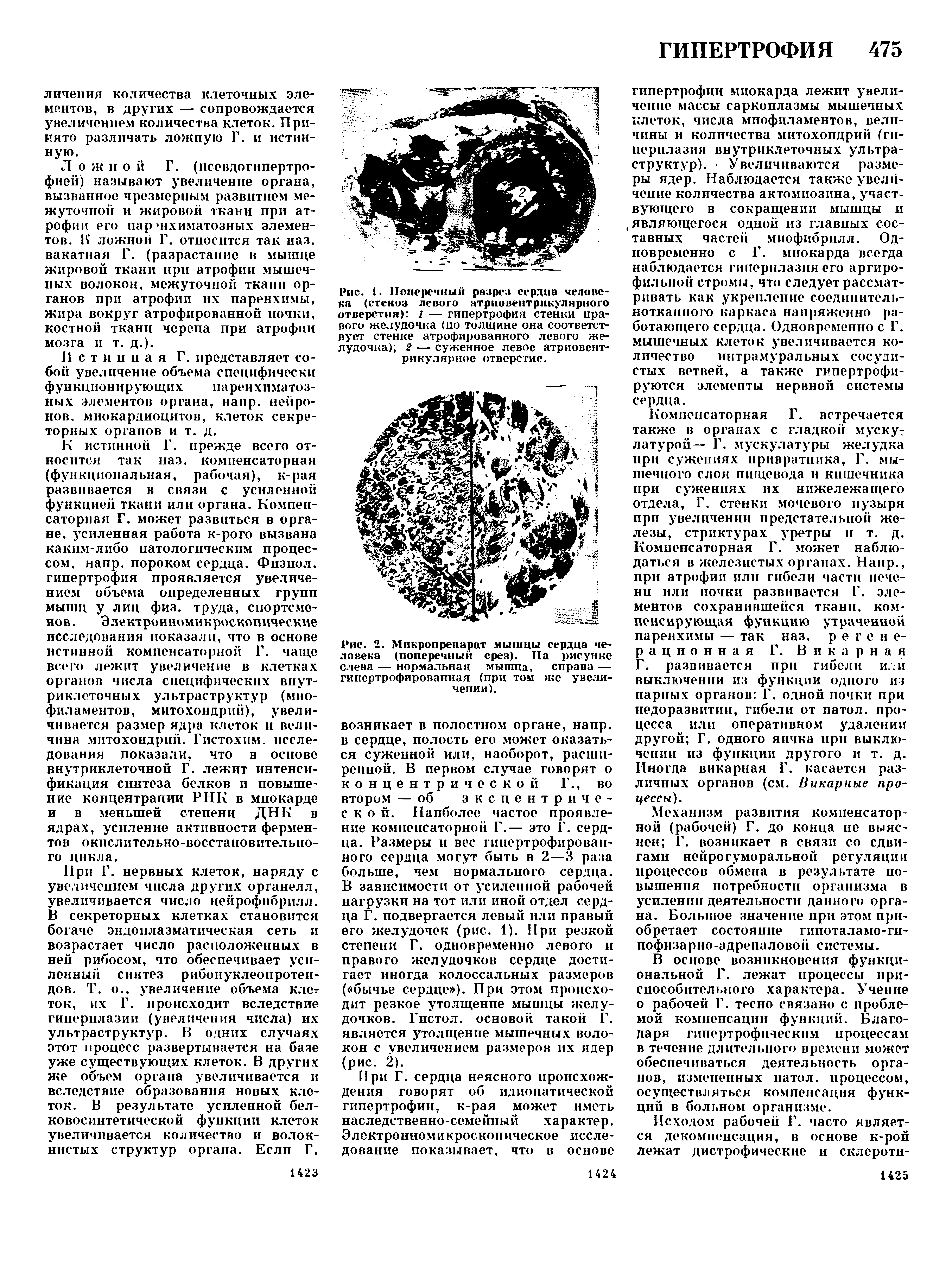 Рис. 2. Микропрепарат мышцы сердца человека (поперечный срез). Па рисунке слева — нормальная мышца, справа — гипертрофированная (при том же увеличении).