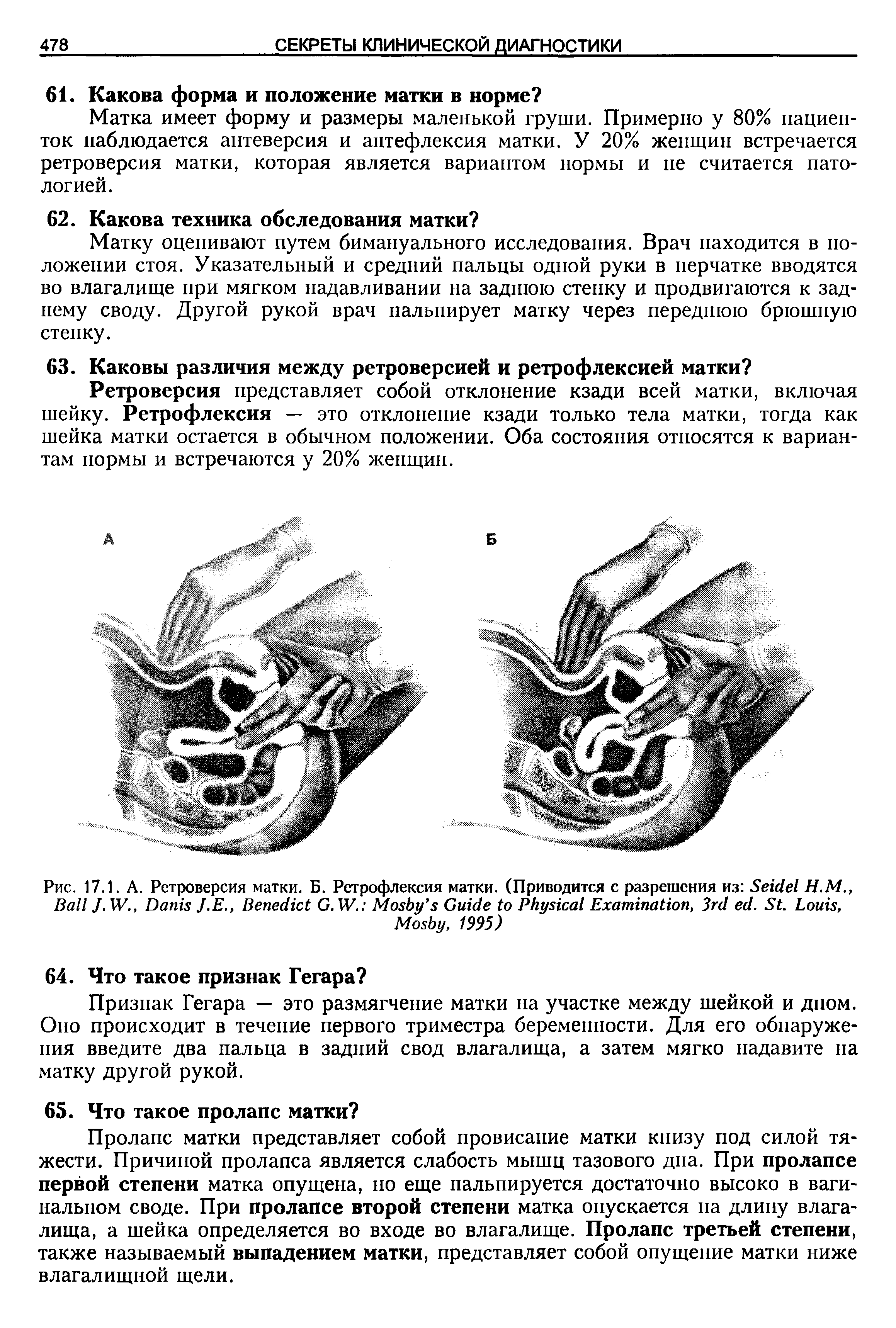 Рис. 17.1. А. Ретроверсия матки. Б. Ретрофлексия матки. (Приводится с разрешения из S Н.М., B J. W., D J.E., B G. W. M G P E , 3 . S . L , M , 1995)...