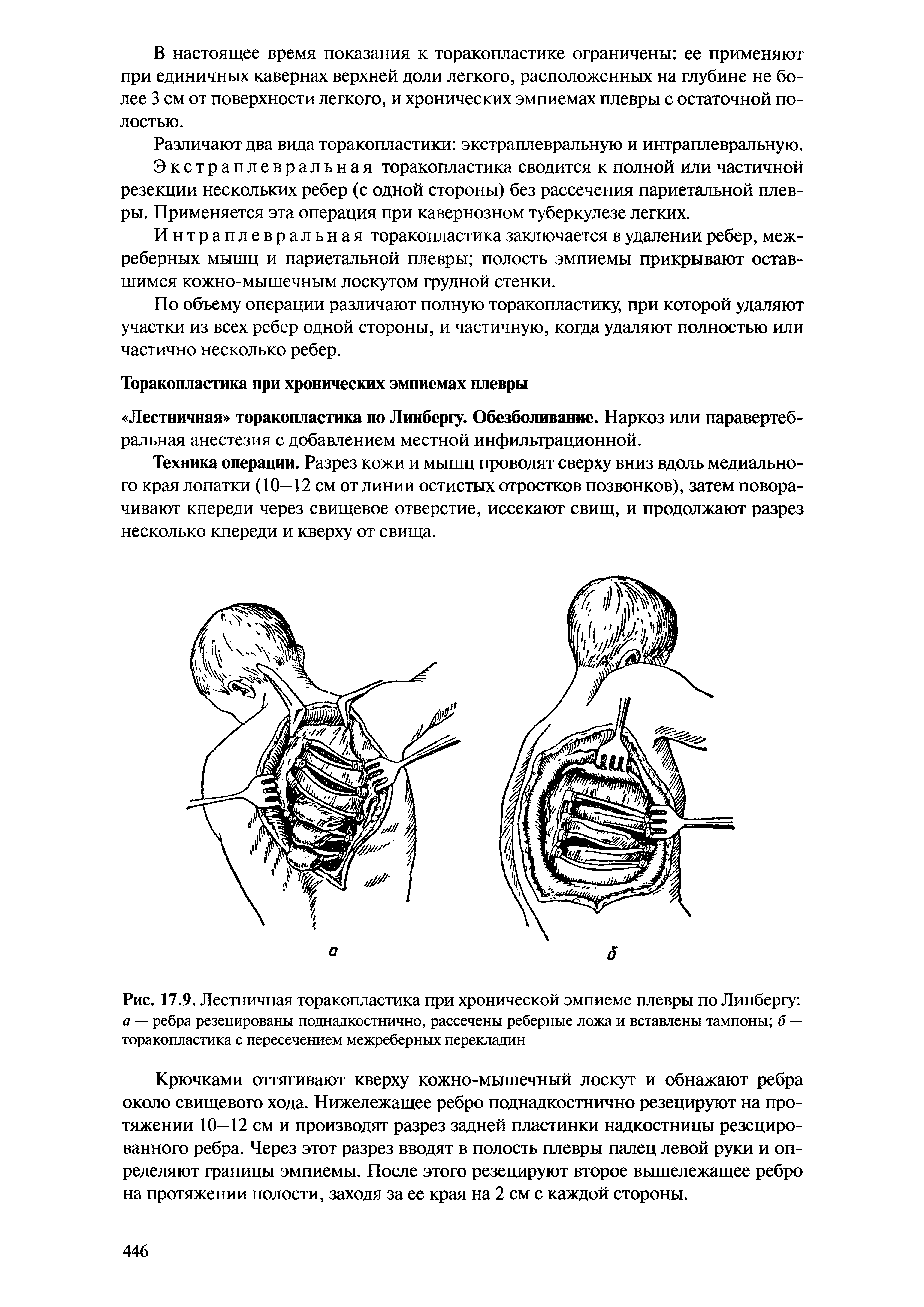 Рис. 17.9. Лестничная торакопластика при хронической эмпиеме плевры по Линбергу а — ребра резецированы поднадкостнично, рассечены реберные ложа и вставлены тампоны б — торакопластика с пересечением межреберных перекладин...