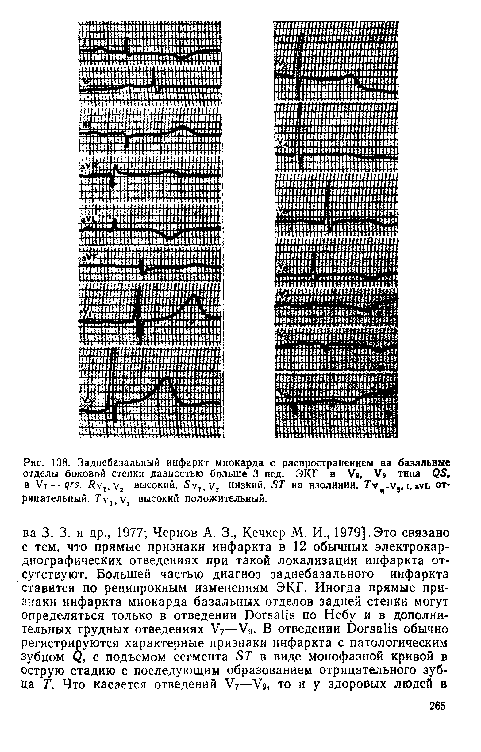 Рис. 138. Заднебазальный инфаркт миокарда с распространением на базальные отделы боковой стенки давностью больше 3 пед. ЭКГ в V , Уэ типа (, в У7— у . Яу1,у2 высокий. 5у, у2 низкий. 57" на изолинии. Ту -у, I, ауь отрицательный. Гу](у2 высокий положительный.