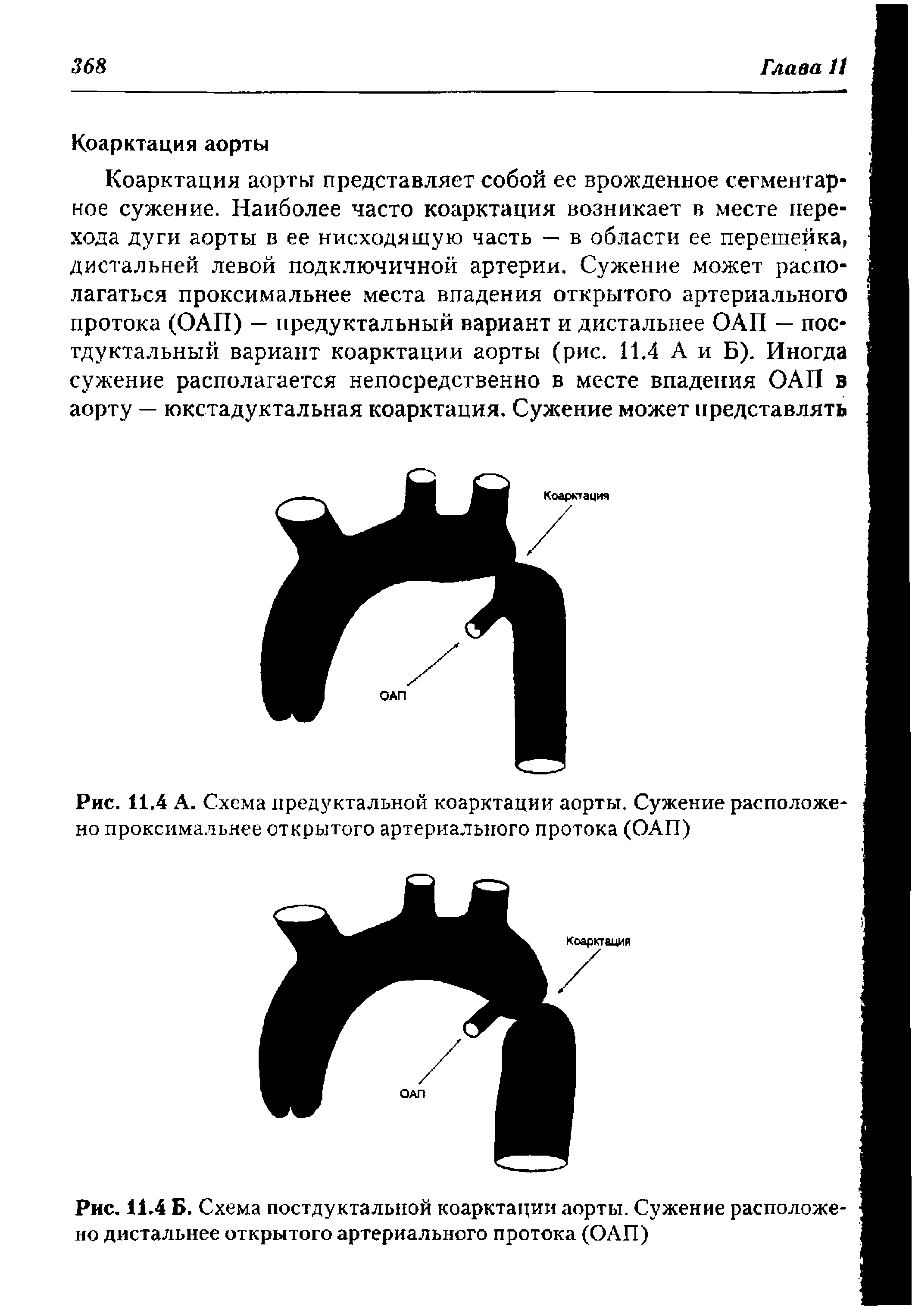 Рис. 11.4 А. Схема предуктальной коарктации аорты. Сужение расположе но проксимальнее открытого артериального протока (ОАП)...