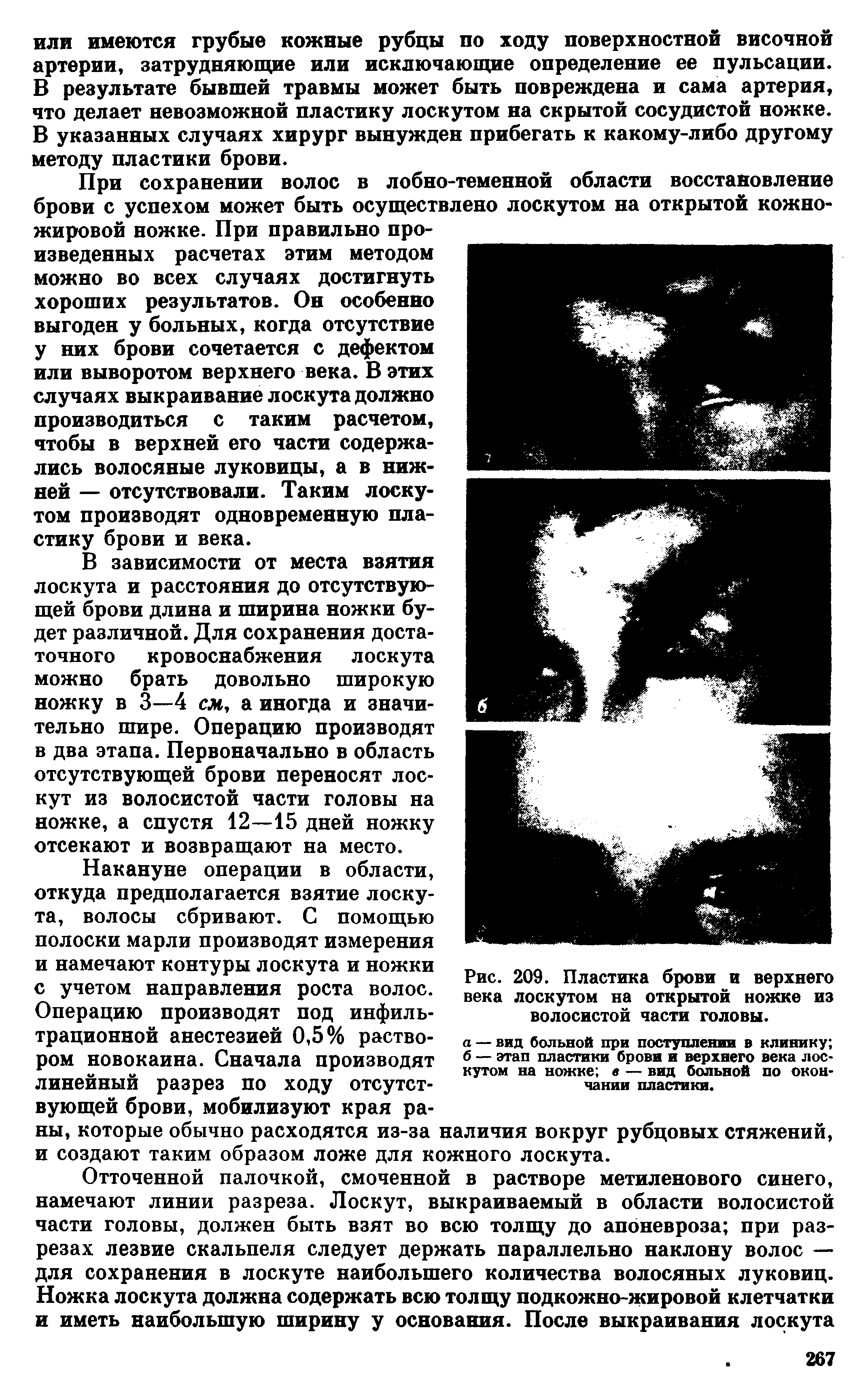 Рис. 209. Пластика брови и верхнего века лоскутом на открытой ножке из волосистой части головы.