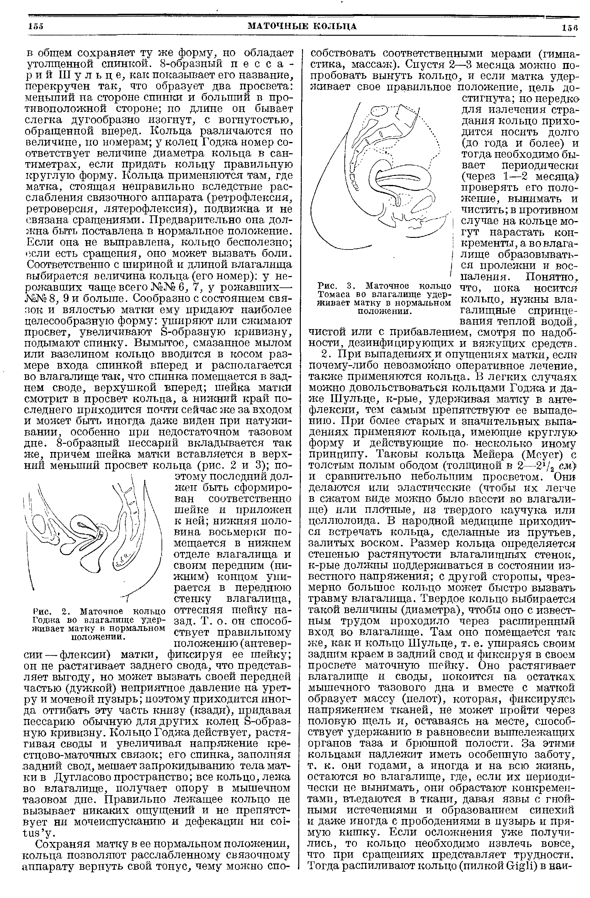 Рис. 3. Маточное кольцо что, пока НОСИТСЯ Томаса во влагалище удер- K JI, . . л живает матку в нормальном "W, . положении. галищные спринце-...