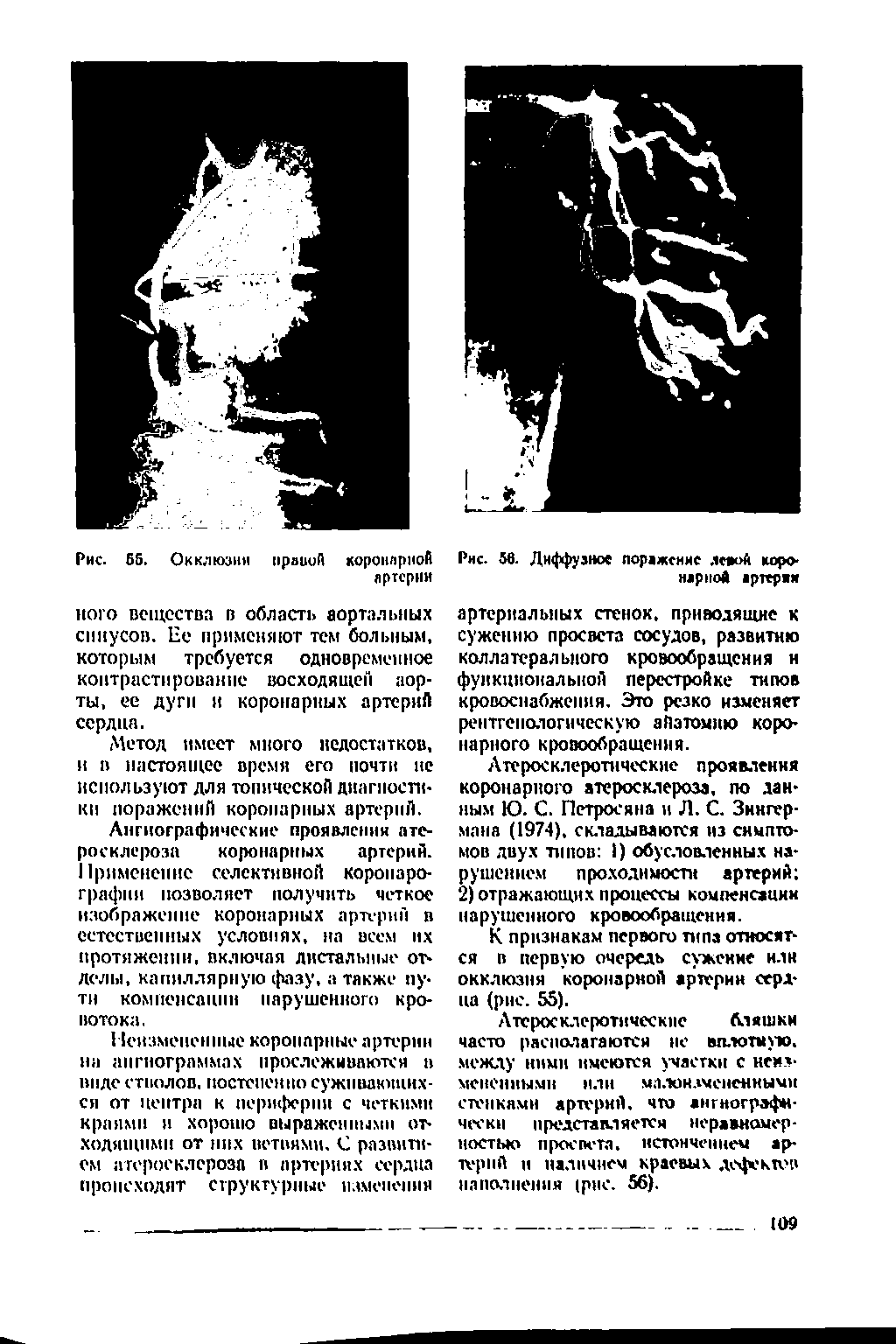 Рис. 56. Диффузное поражение левой коронарной артеряя артериальных стенок, приводящие к сужению просвета сосудов, развитию коллатерального кровообращения и функциональной перестройке типов кровоснабжения. Это резко изменяет рентгенологическую аПатомию коронарного кровообращения.